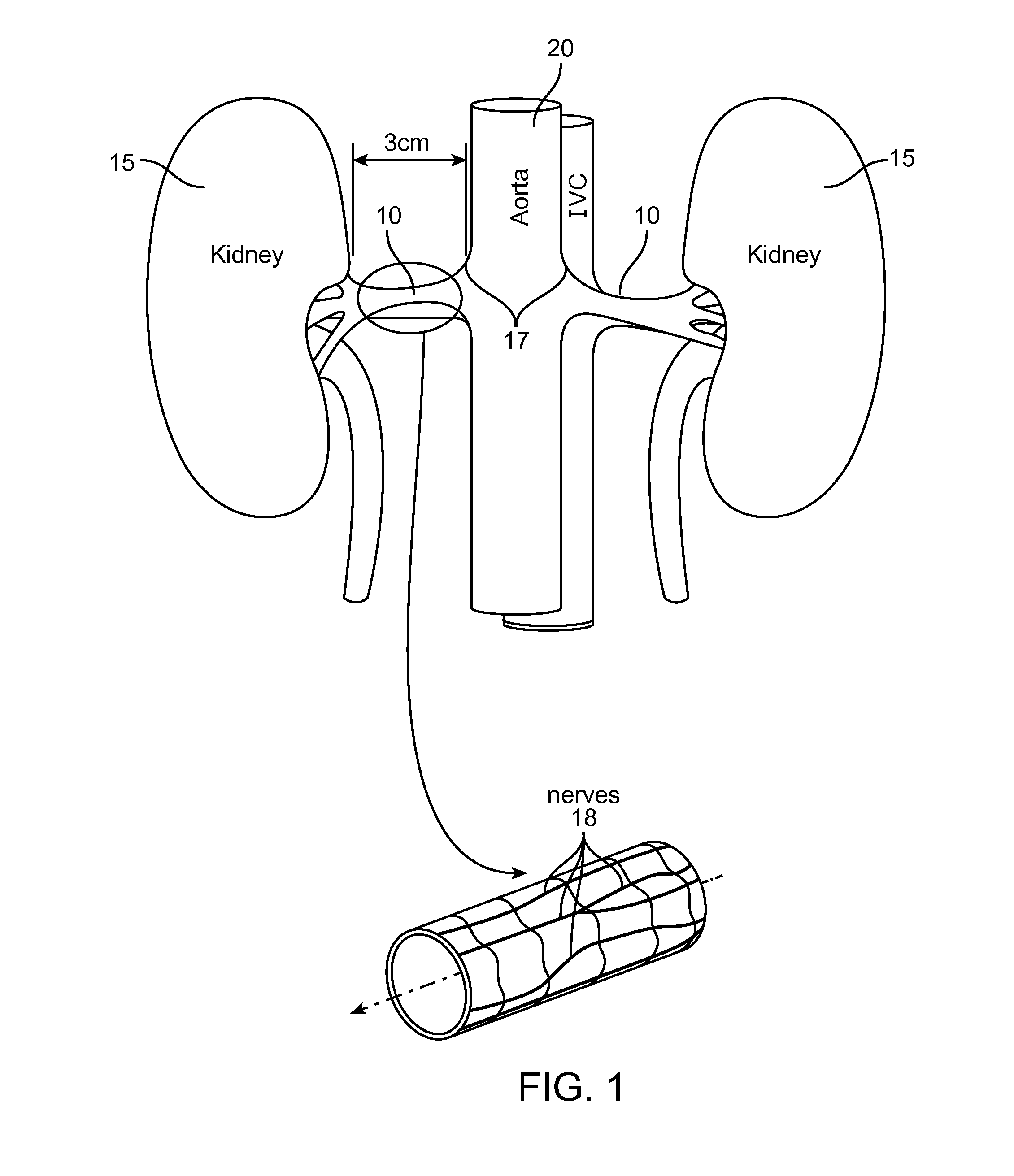Method and apparatus employing ultrasound energy to remodulate vascular nerves