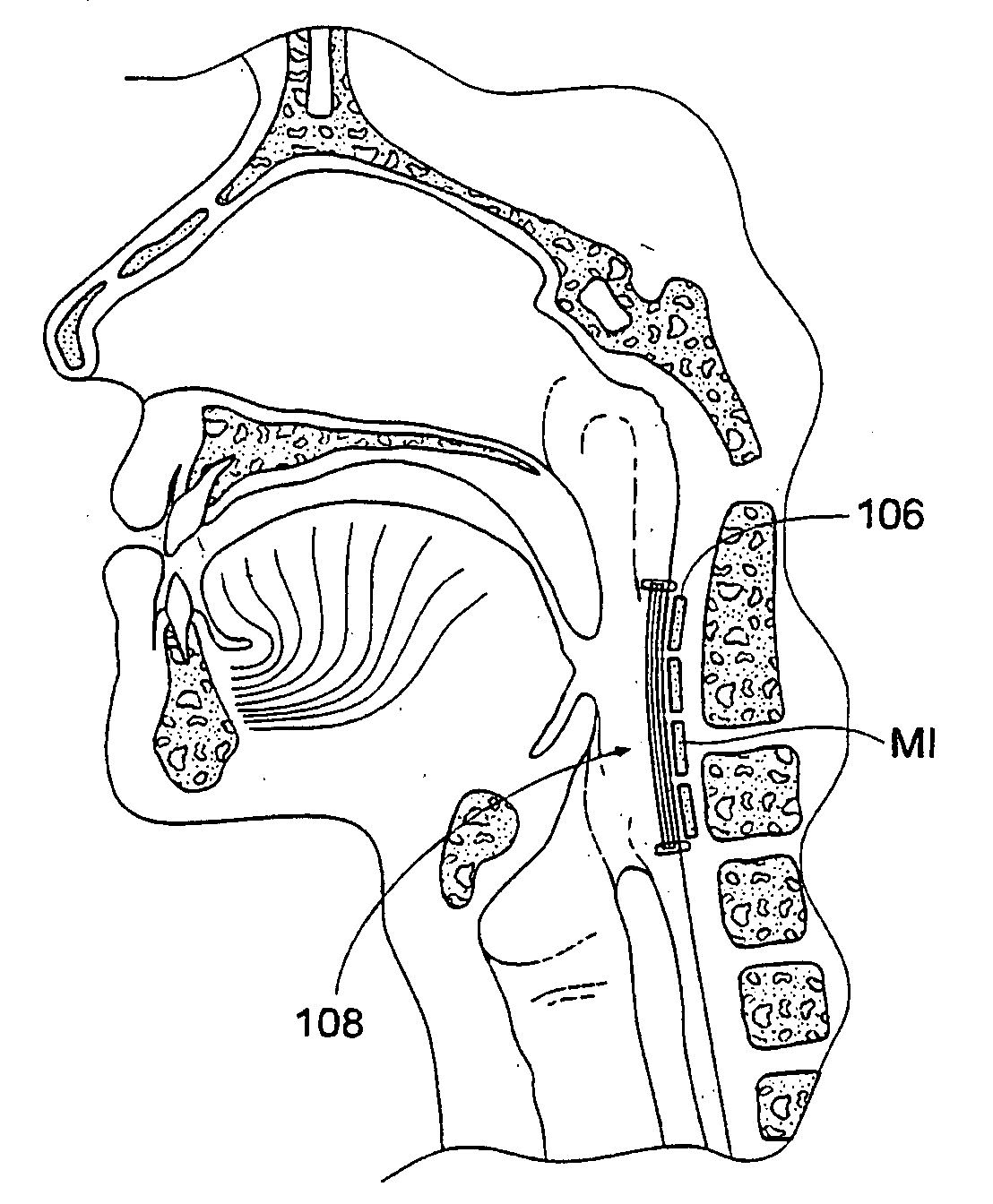 Magnetic force device, systems, and methods for resisting tissue collapse within the pharyngeal conduit