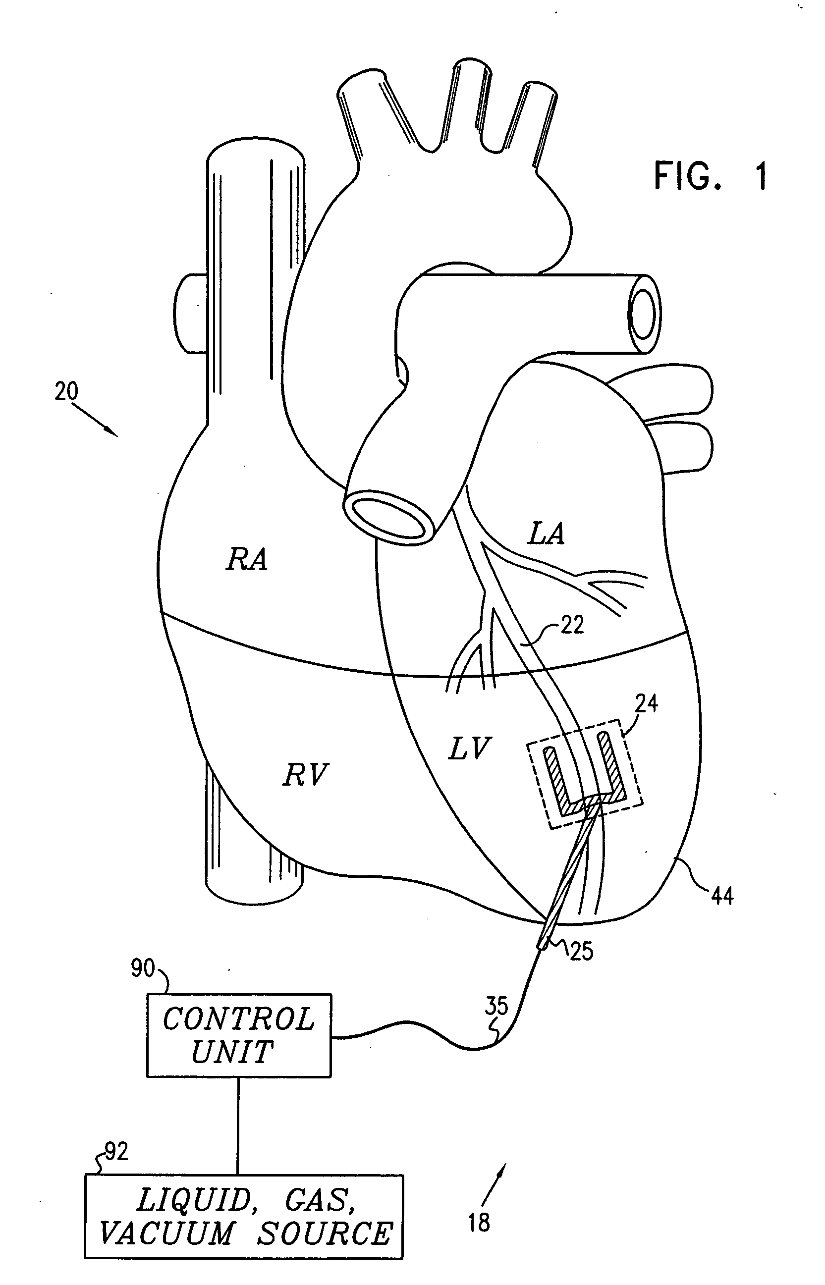 Local cardiac motion control using applied signals and mechanical force