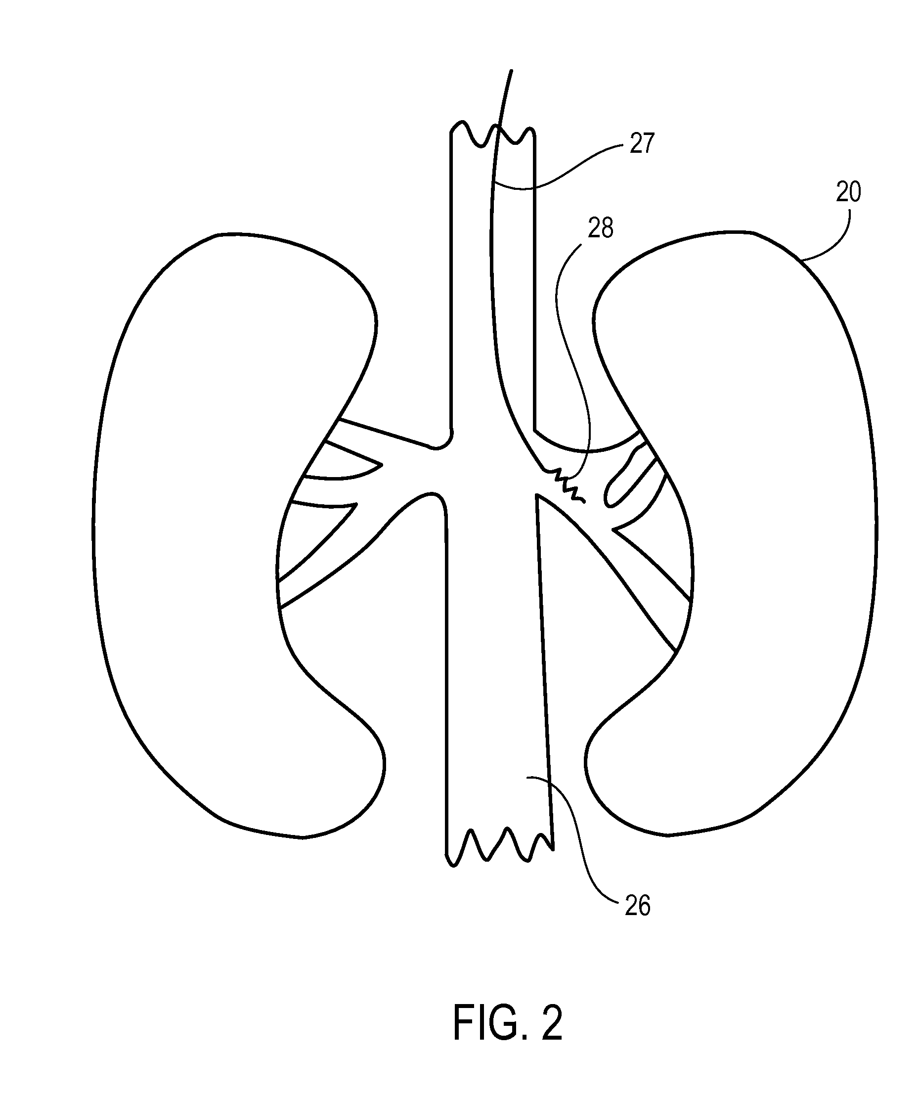 Methods and materials for treating syncope
