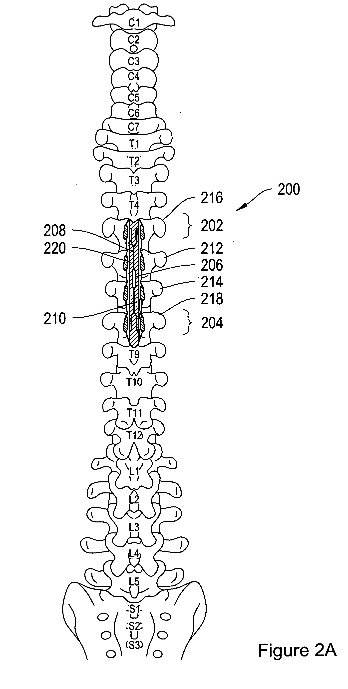 Spinal cord implant systems and methods