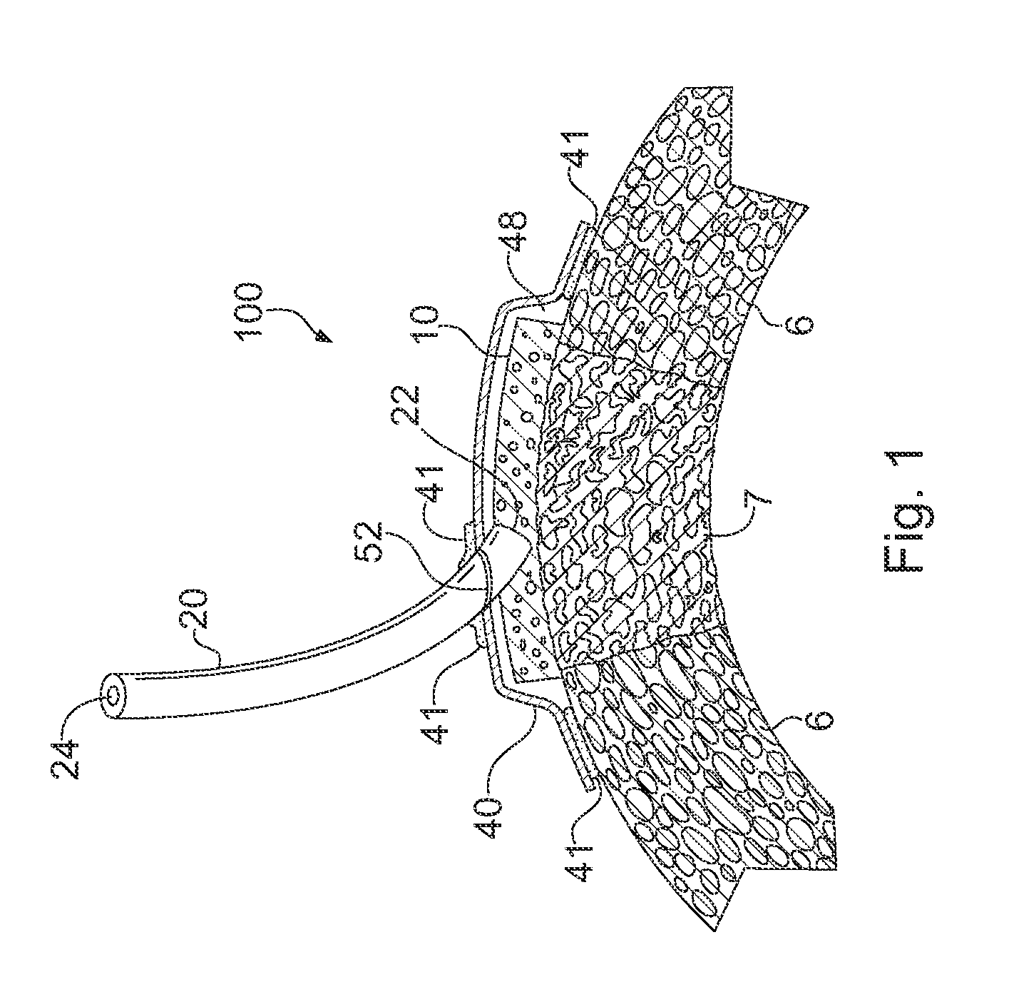 Apparatus and Method for Cardiac Tissue Modulation by Topical Application of Vacuum to Minimize Cell Death and Damage