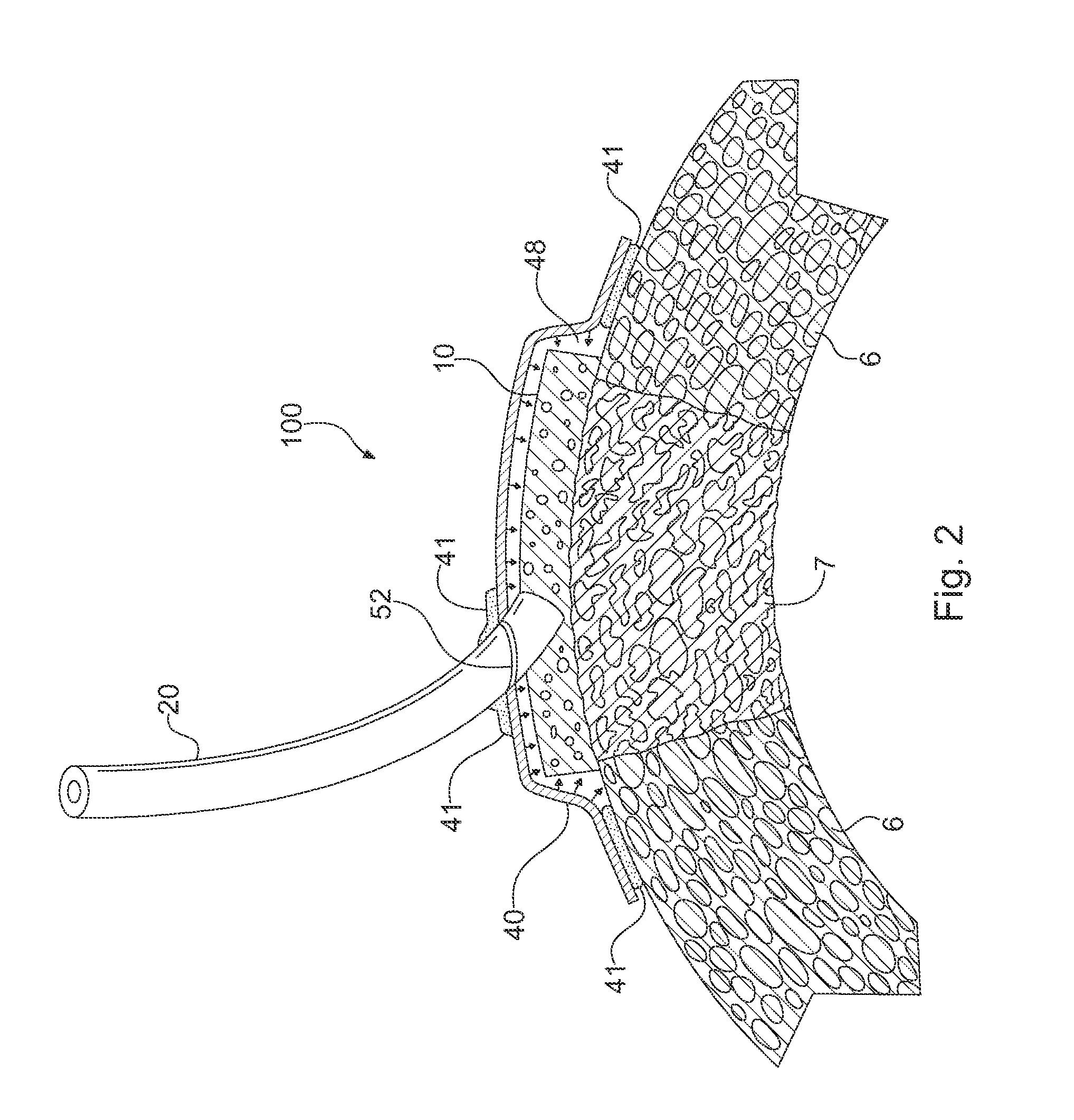 Apparatus and Method for Cardiac Tissue Modulation by Topical Application of Vacuum to Minimize Cell Death and Damage