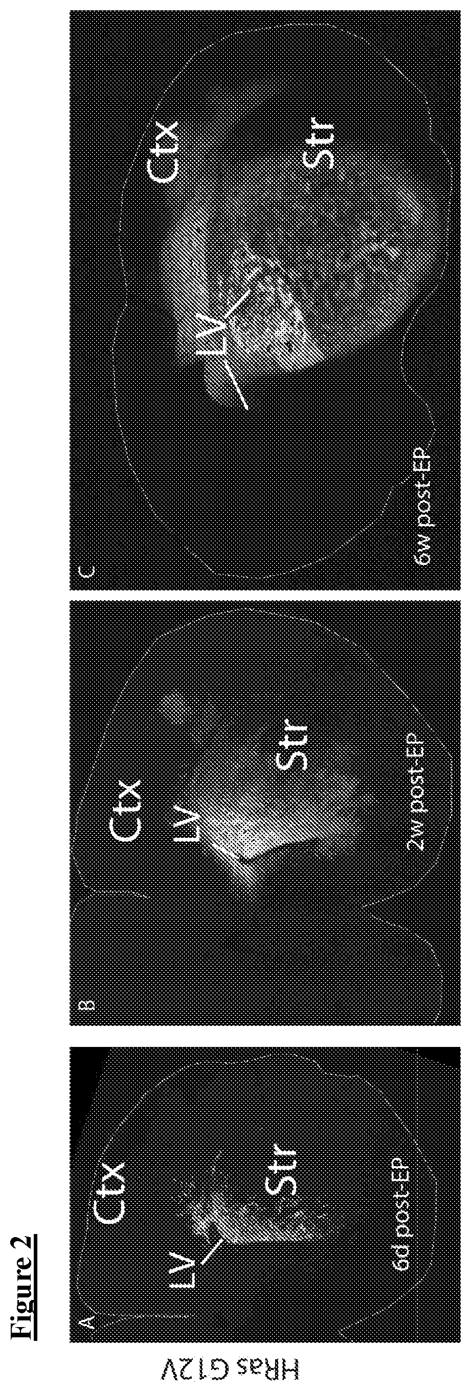 ETS factors regulate neural stem cell depletion and gliogenesis in Ras pathway glioma