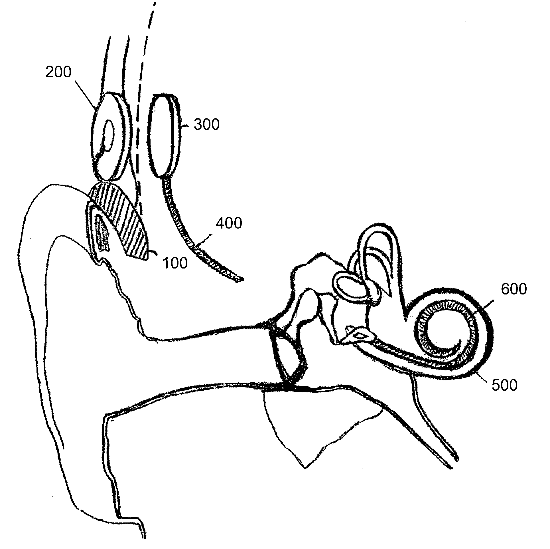 Cochlear implant with improved electrode array and controller - Eureka ...