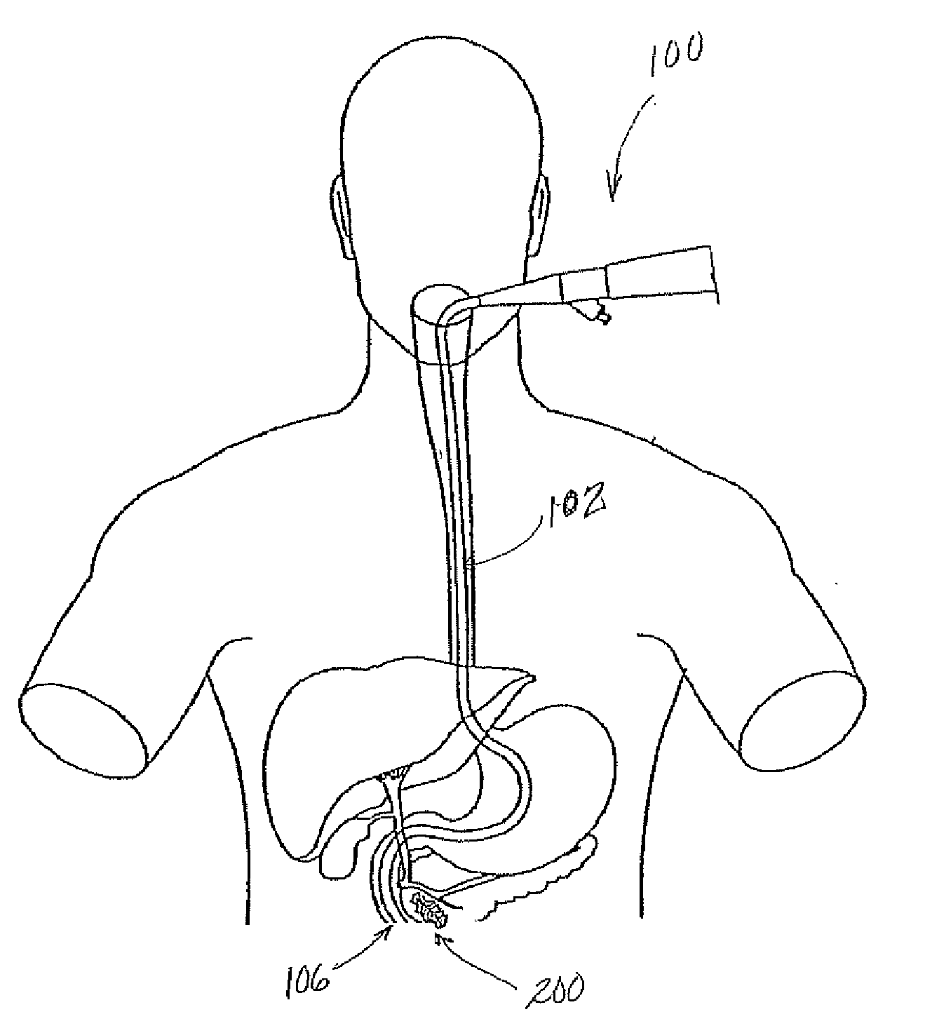 Stent based method and apparatus for directing external beam radiation therapy