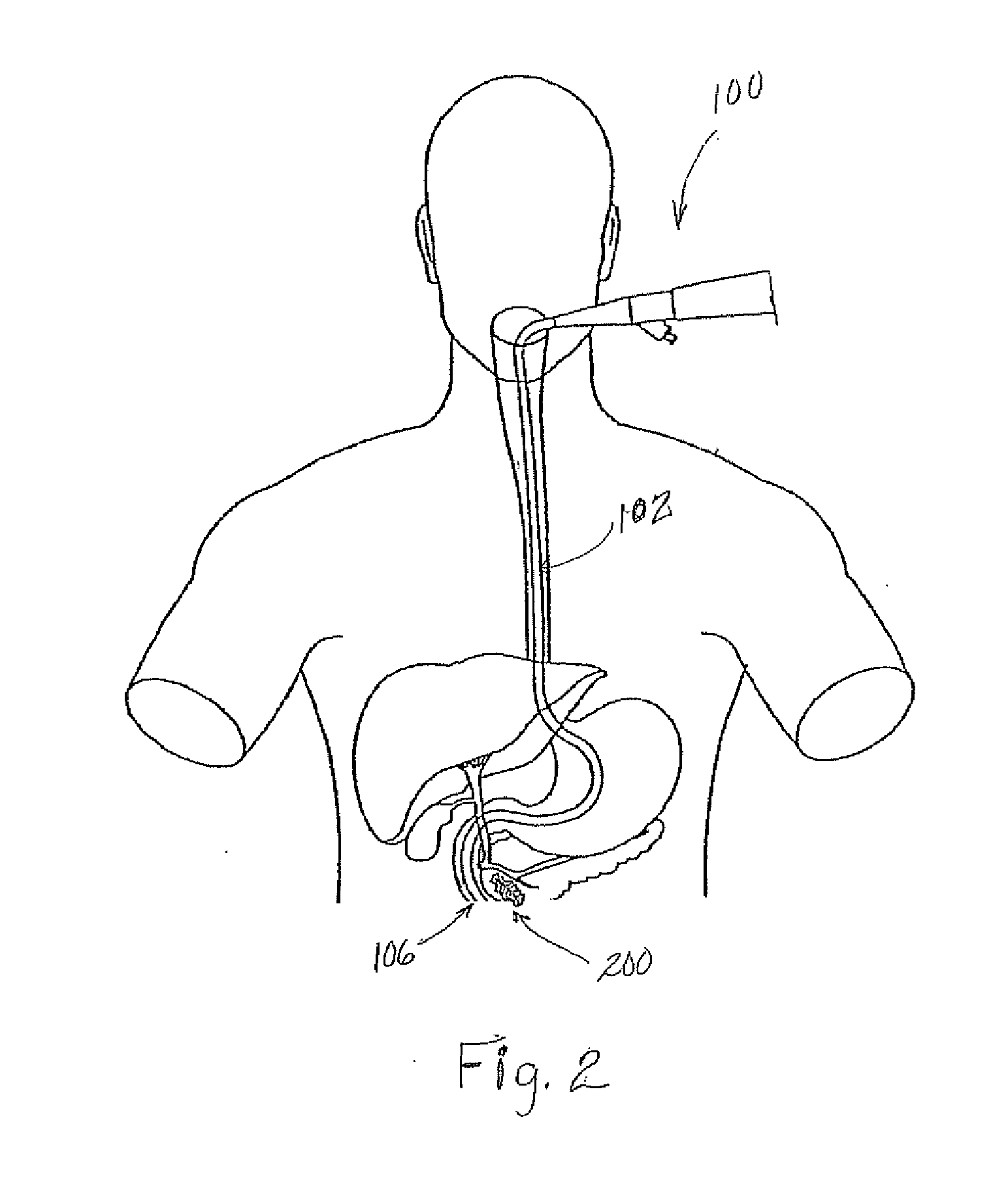 Stent based method and apparatus for directing external beam radiation therapy