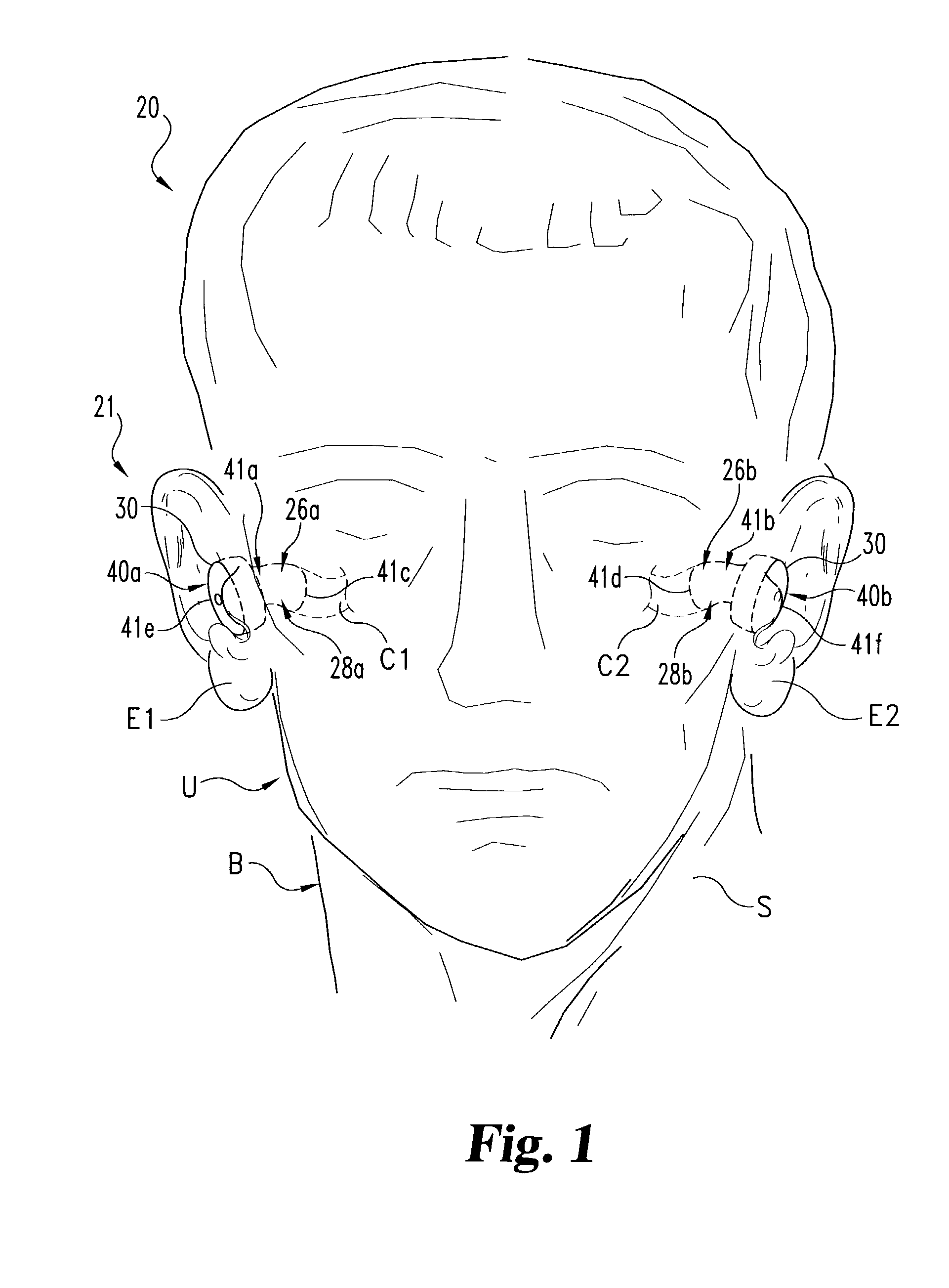 Electrode placement for wireless intrabody communication between components of a hearing system