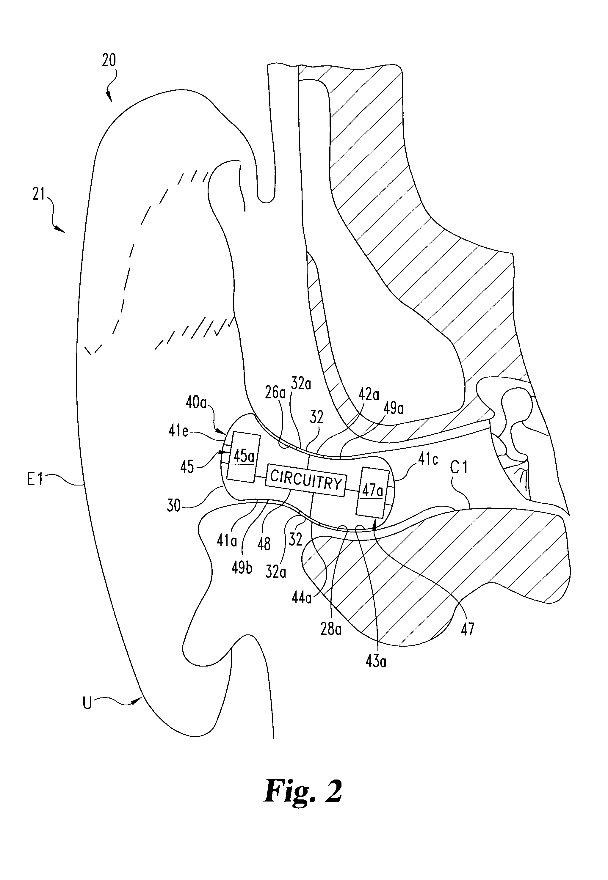 Electrode placement for wireless intrabody communication between components of a hearing system