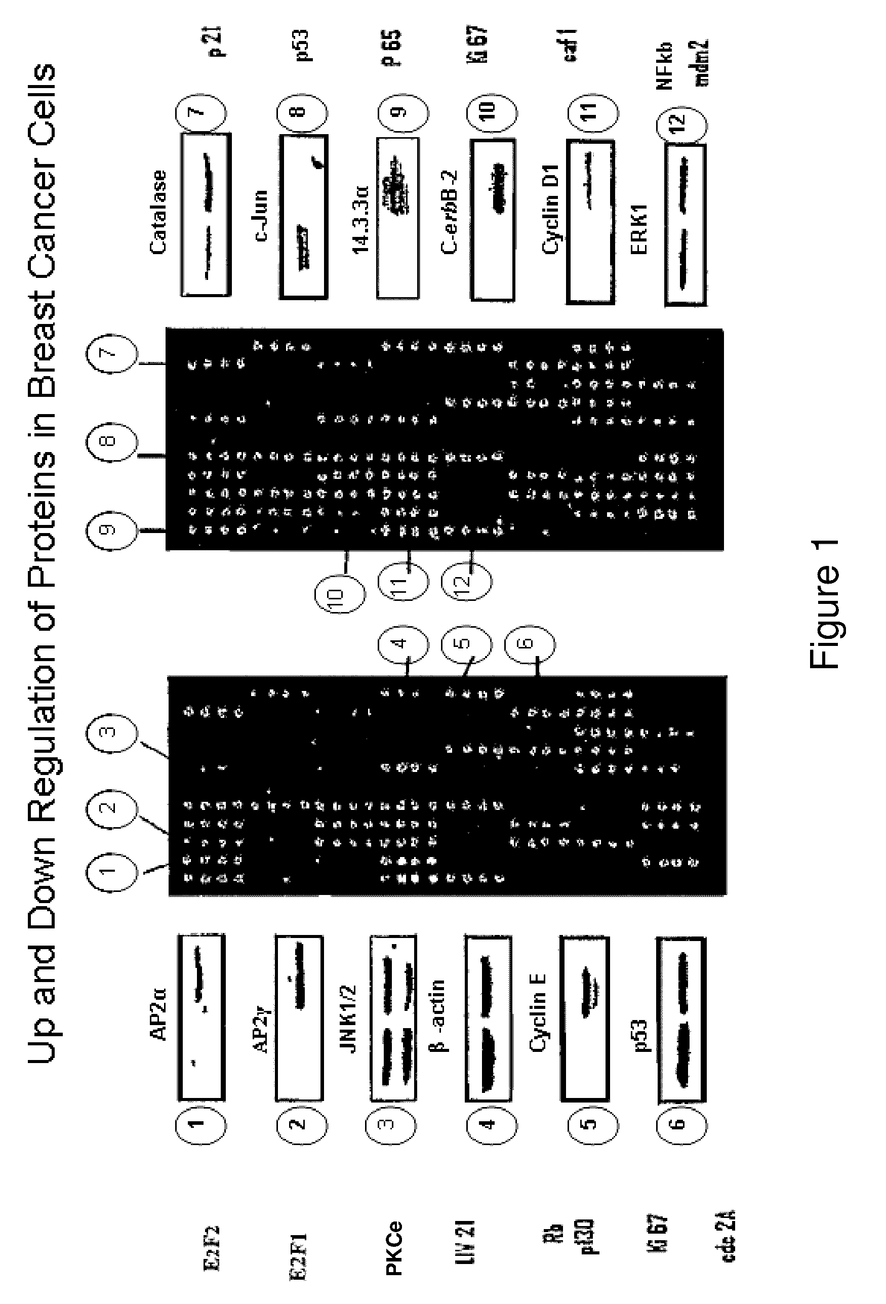 Diagnosis method and treatment for cancer using liv21 proteins and E2F1/E2F4 biomarkers