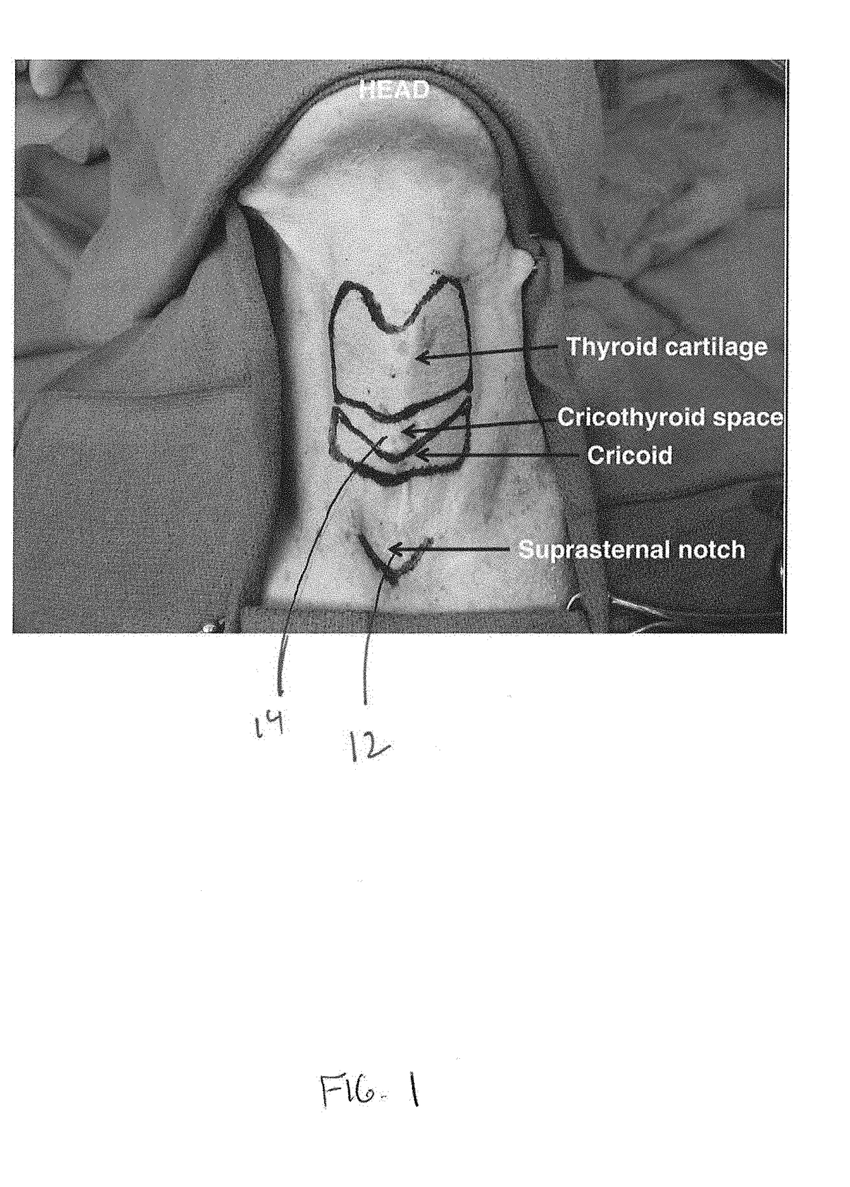 Cricotherotomy apparatus and method