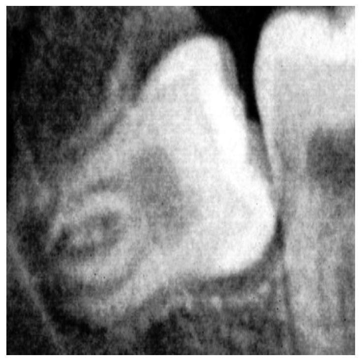 Oral cavity curved image wisdom tooth segmentation method based on YOLO and U-Net