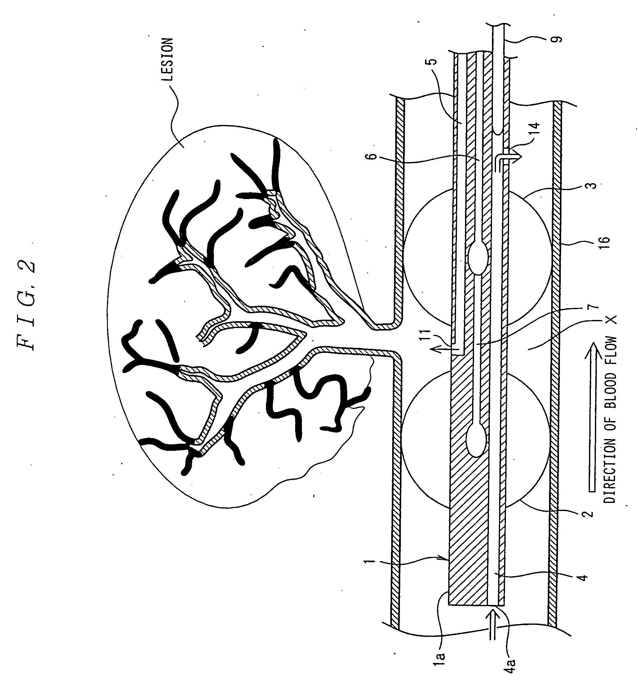 Balloon catheter and device for injecting medical treatment method