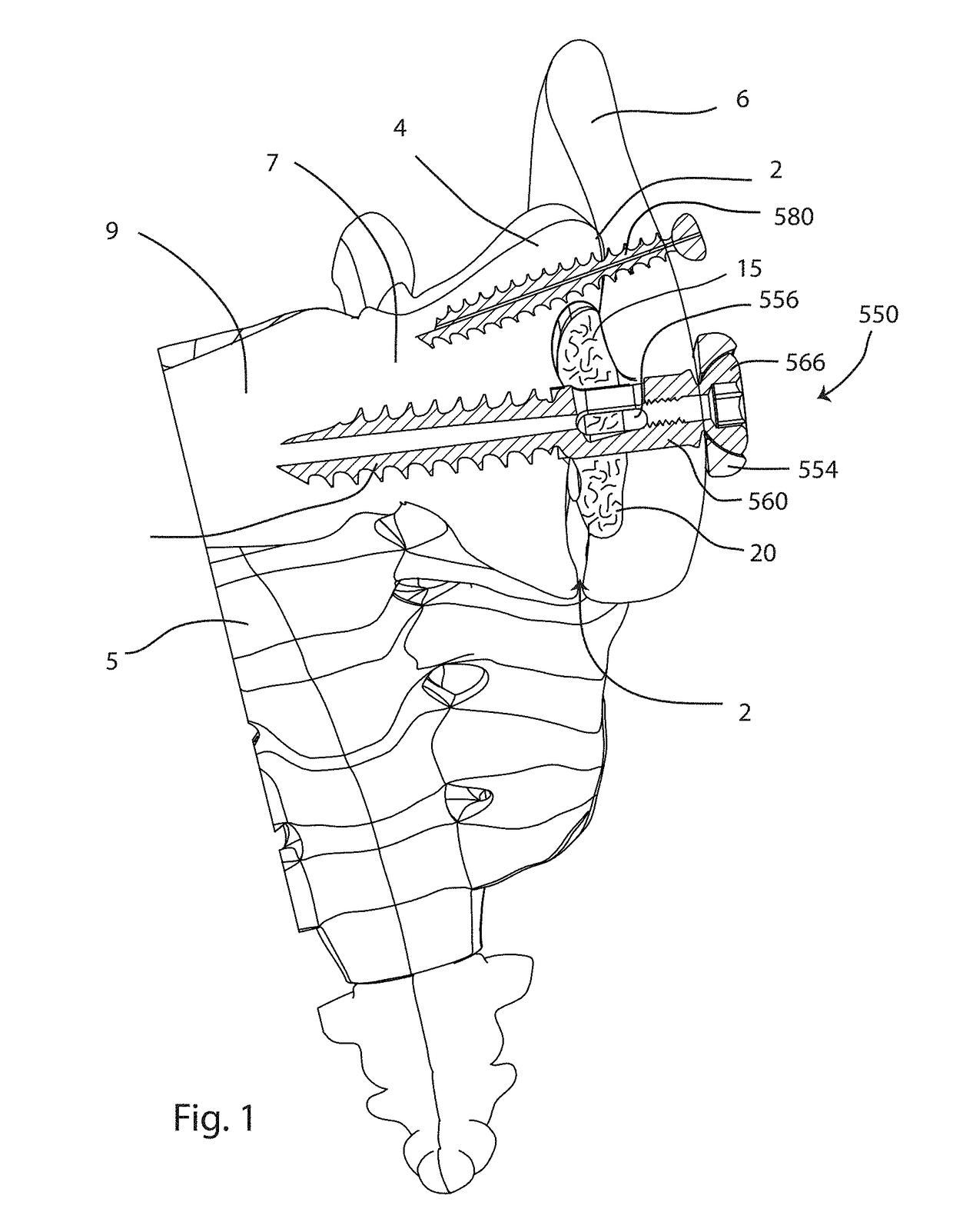 Joint fusion implant and methods