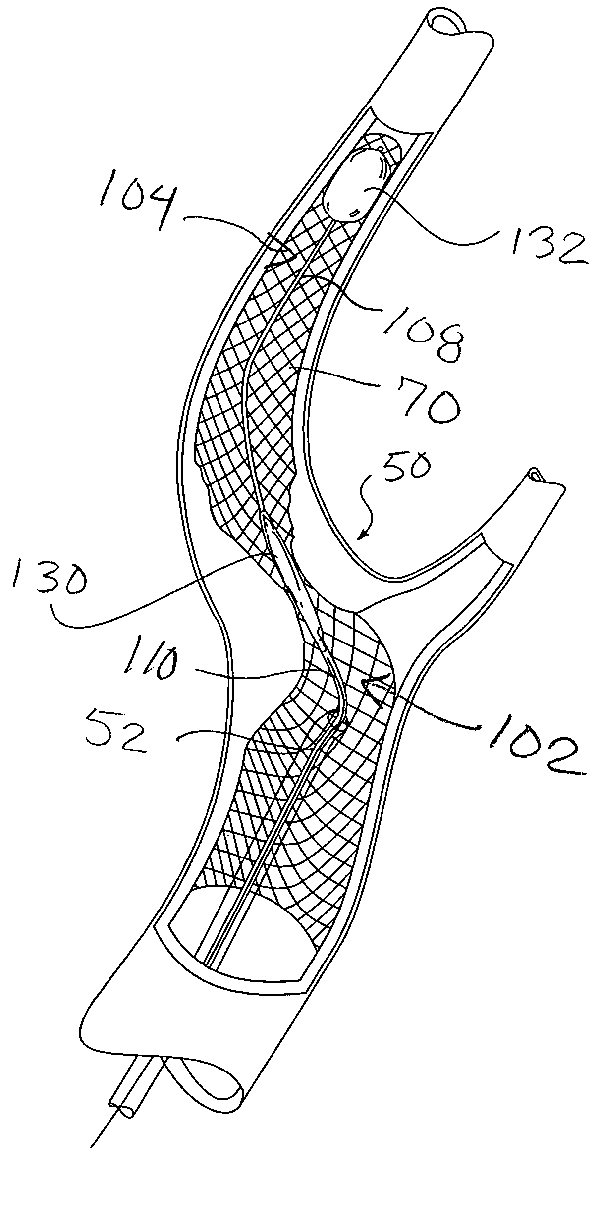 Method of performing protected angioplasty and stenting at a carotid bifurcation