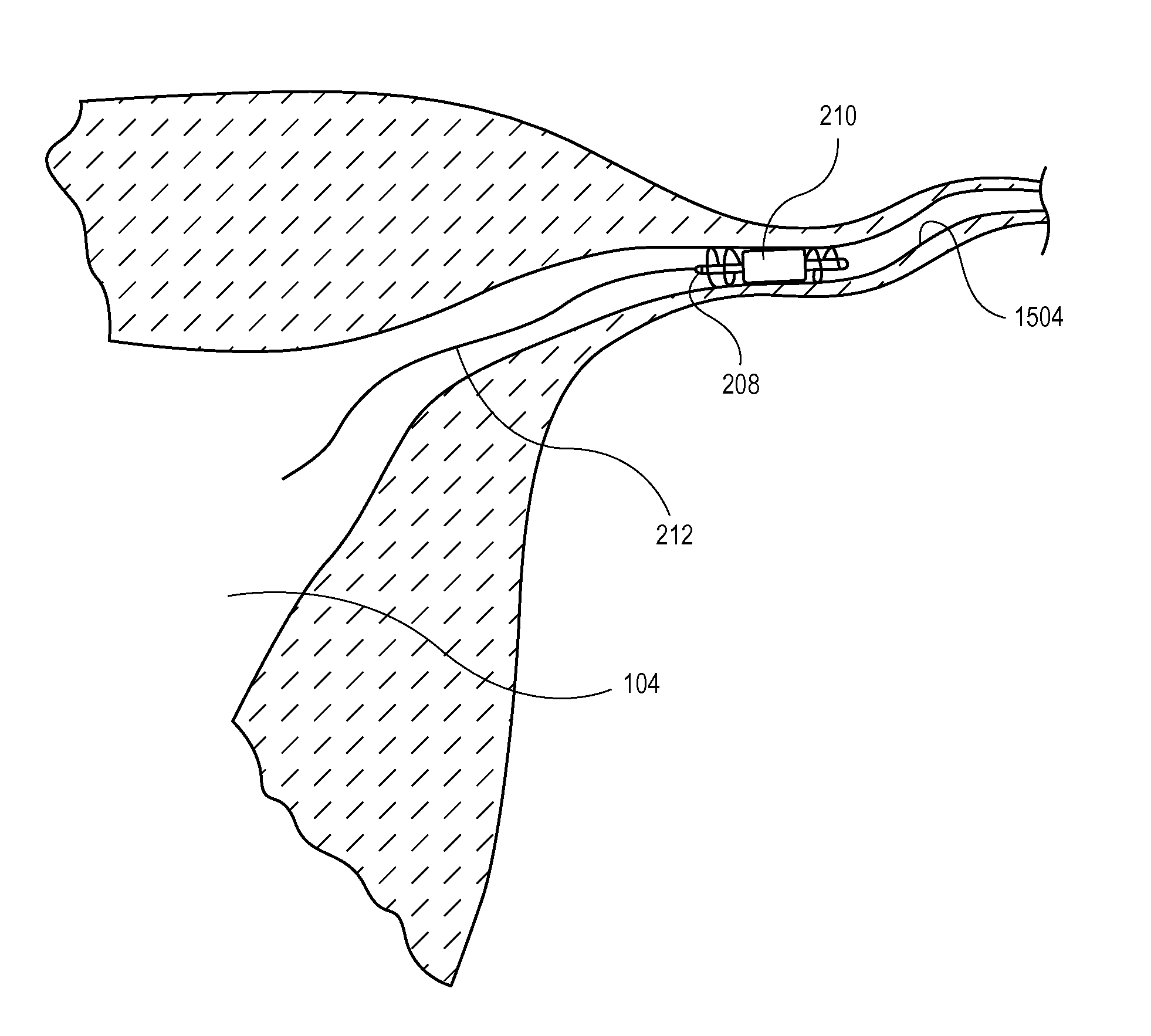 Occlusion device with openable channel