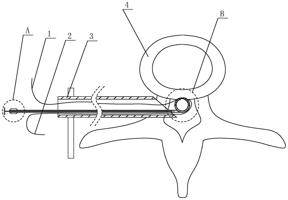 Rapid fibrous ring suturing device and suturing method after intervertebral disc herniation surgery