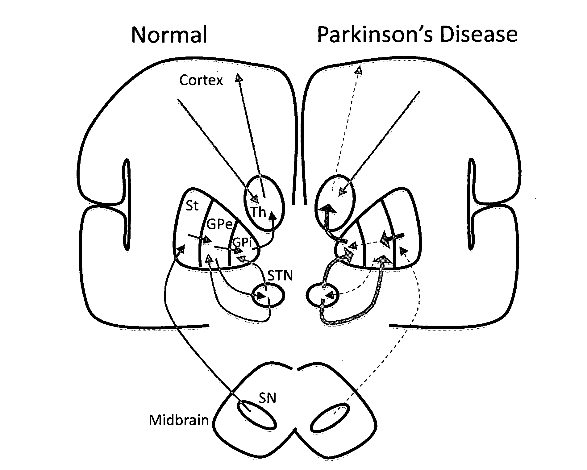 Model Based Control of Parkinson's Disease