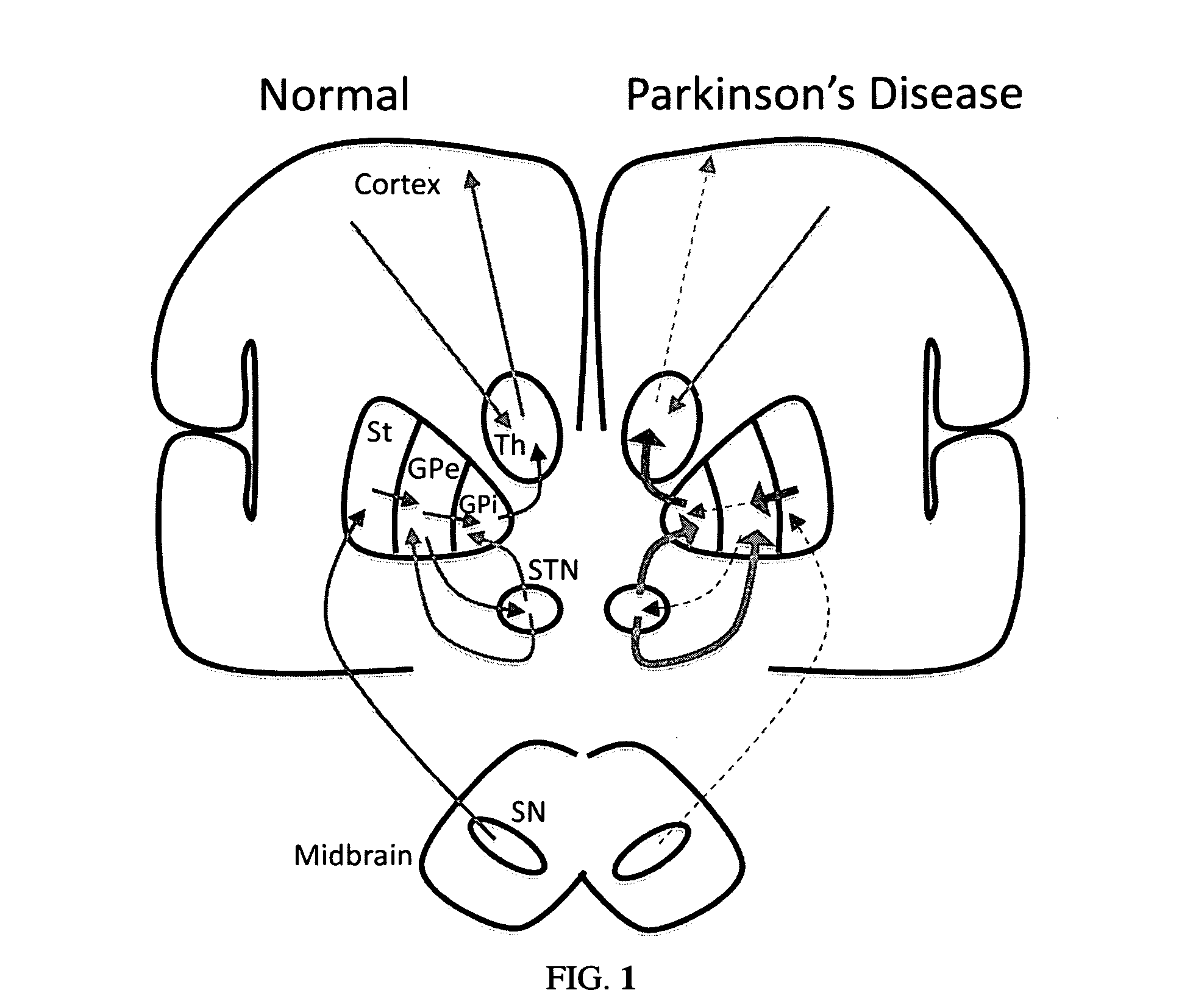 Model Based Control of Parkinson's Disease