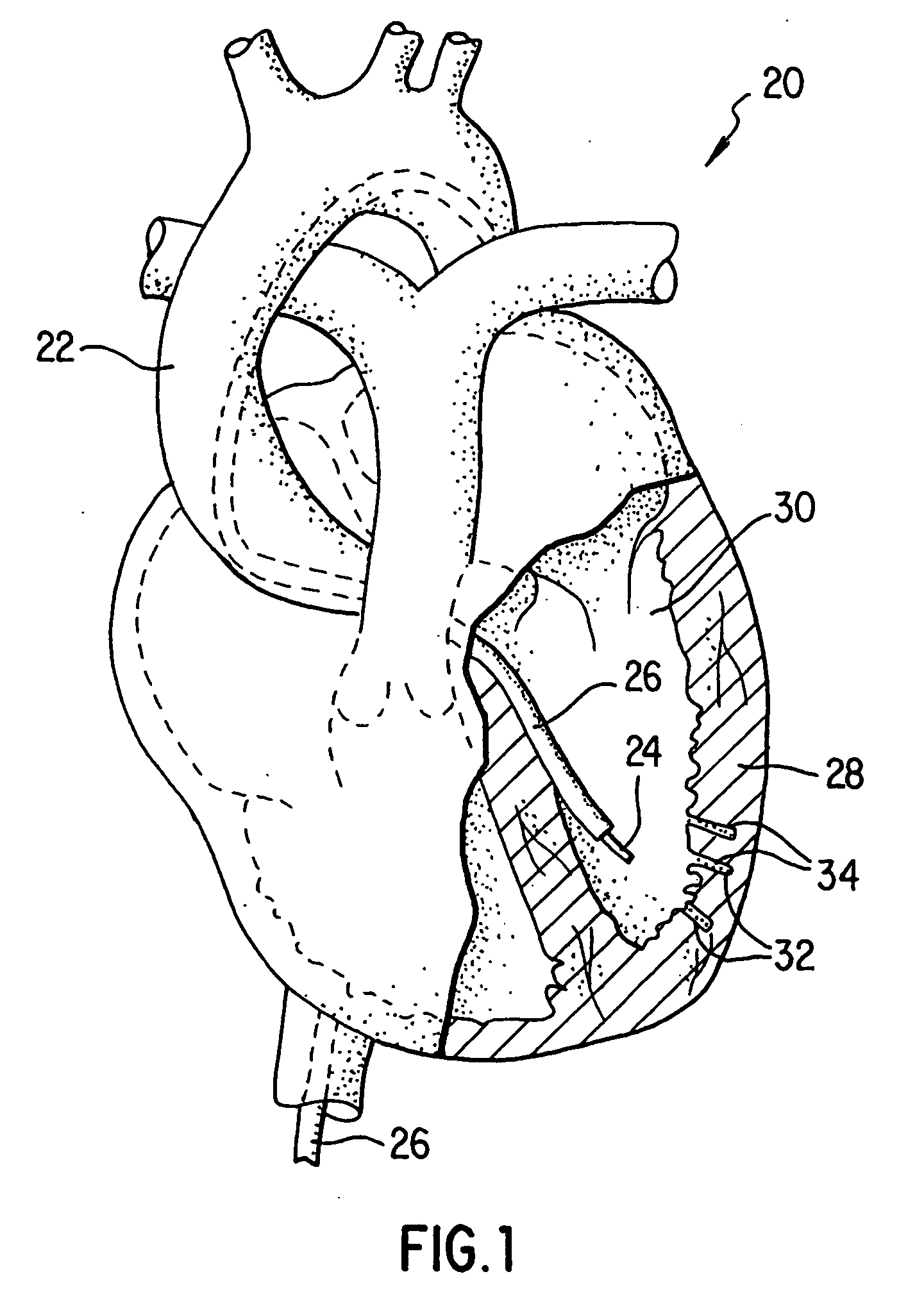 Catheter for the delivery of therapeutic agents to tissues