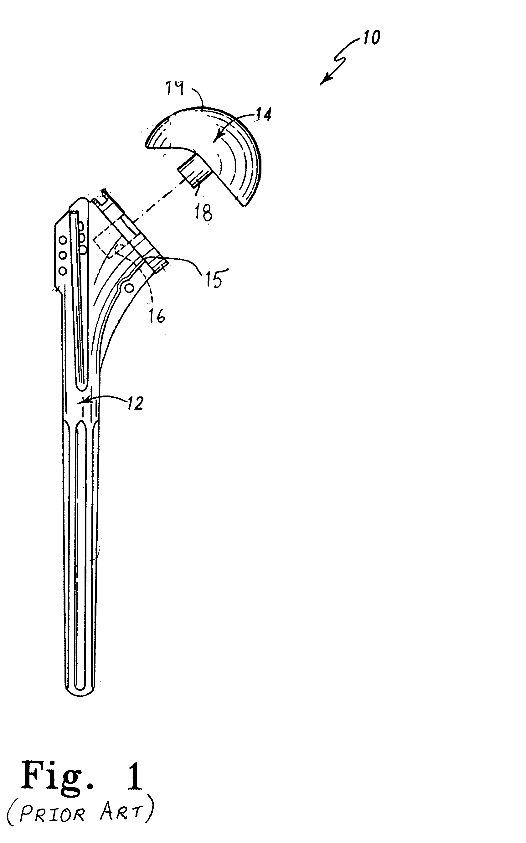Joint prosthesis with infinitely positionable head