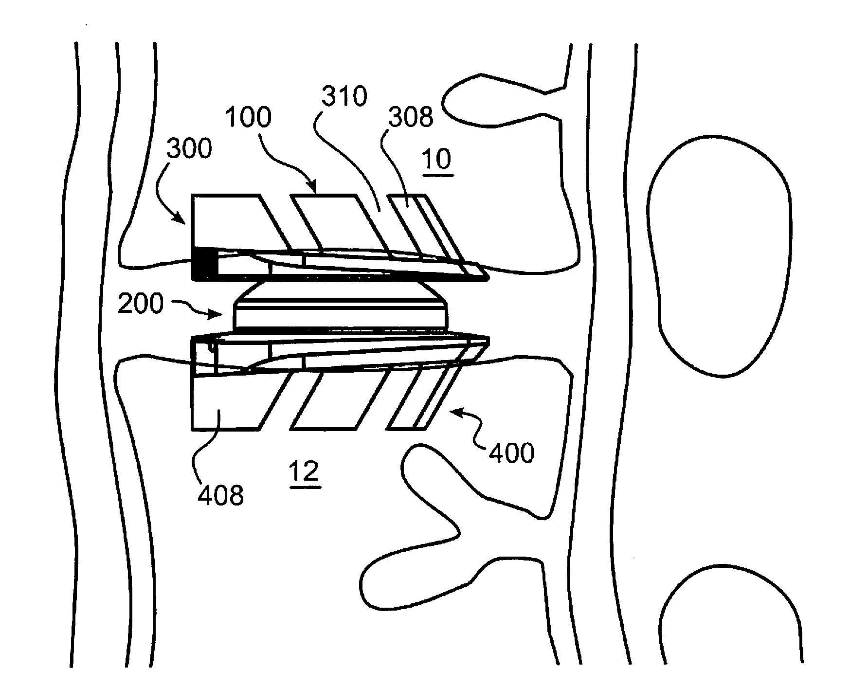 Six Degree Spine Stabilization Devices and Methods