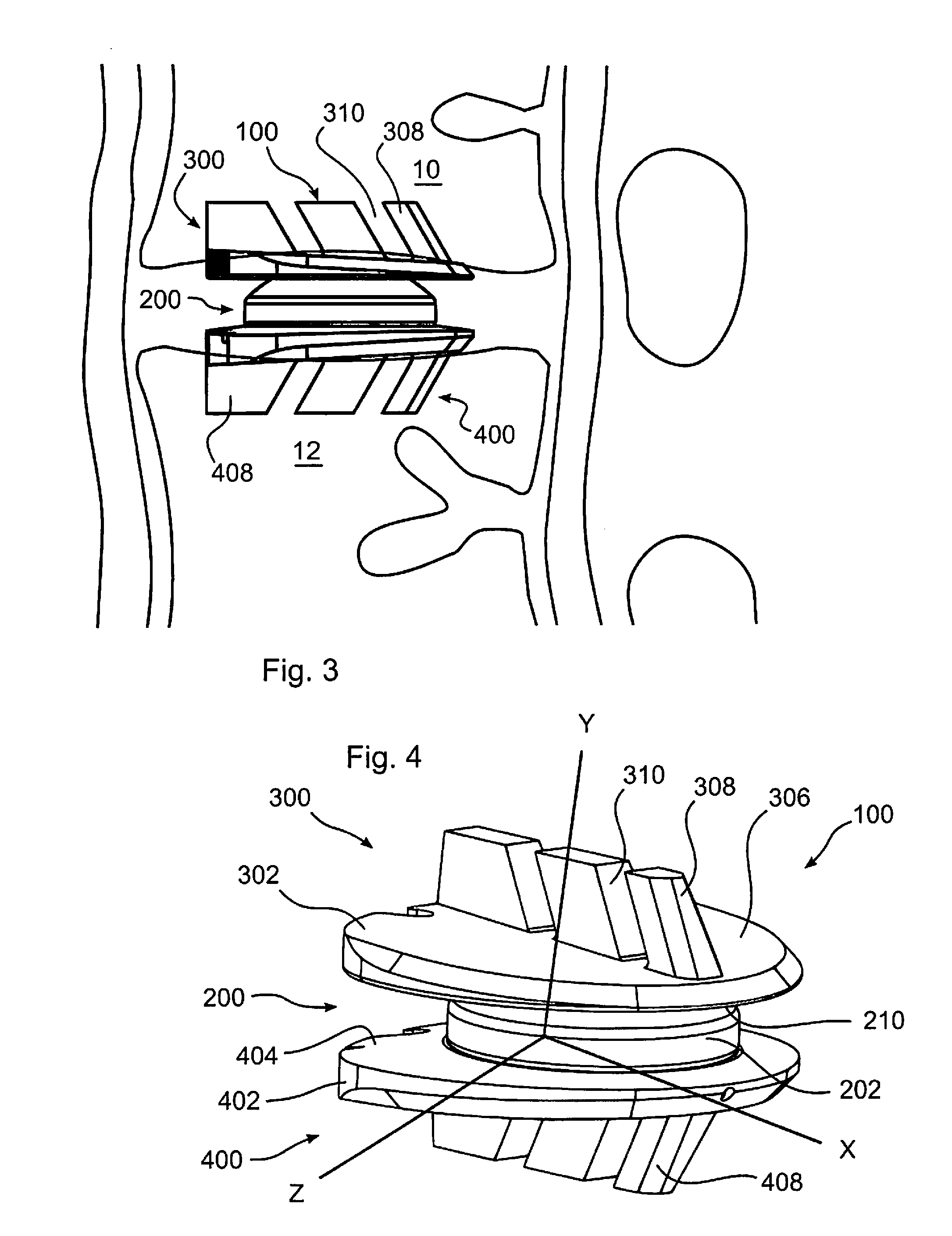 Six Degree Spine Stabilization Devices and Methods