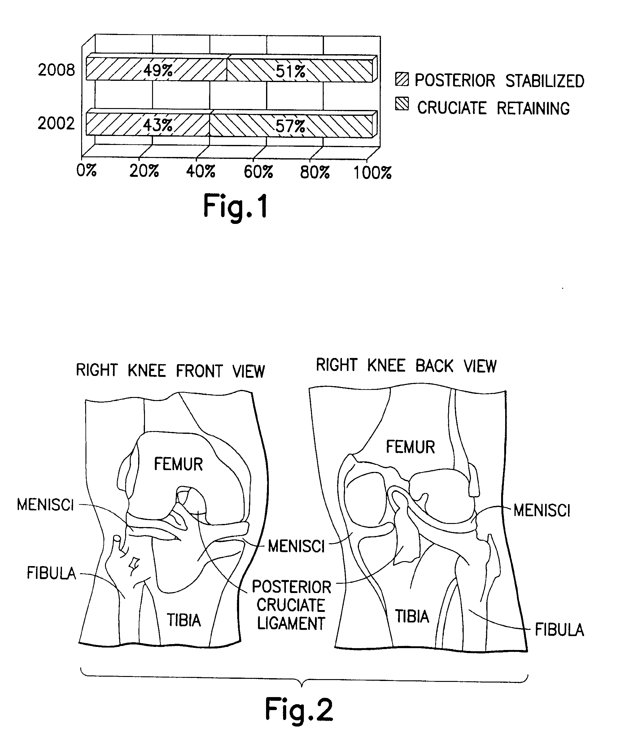 Systems and methods relating to a knee prosthesis capable of conversion from a cruciate retaining type prosthesis to a posterior stabilizng type prosthesis