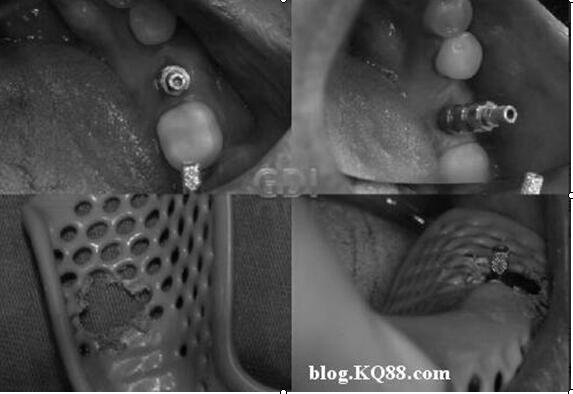 A detachable dental implant bracket and its use method
