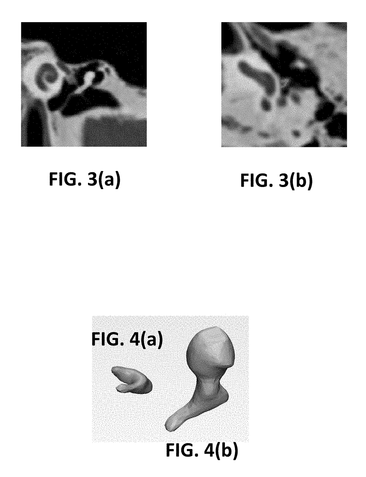 Ossicular prosthesis and method and system for manufacturing same