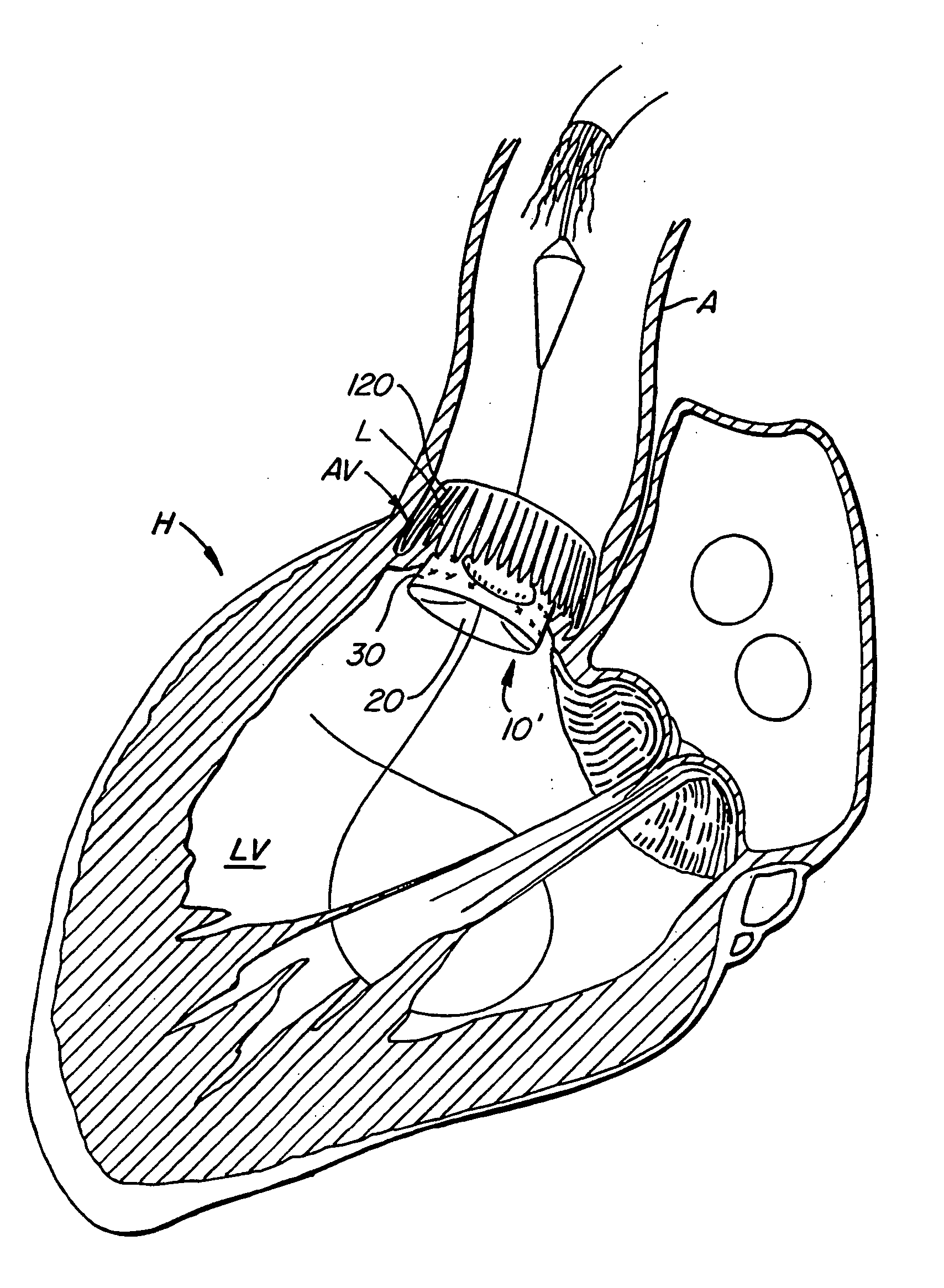 Repositionable heart valve and method