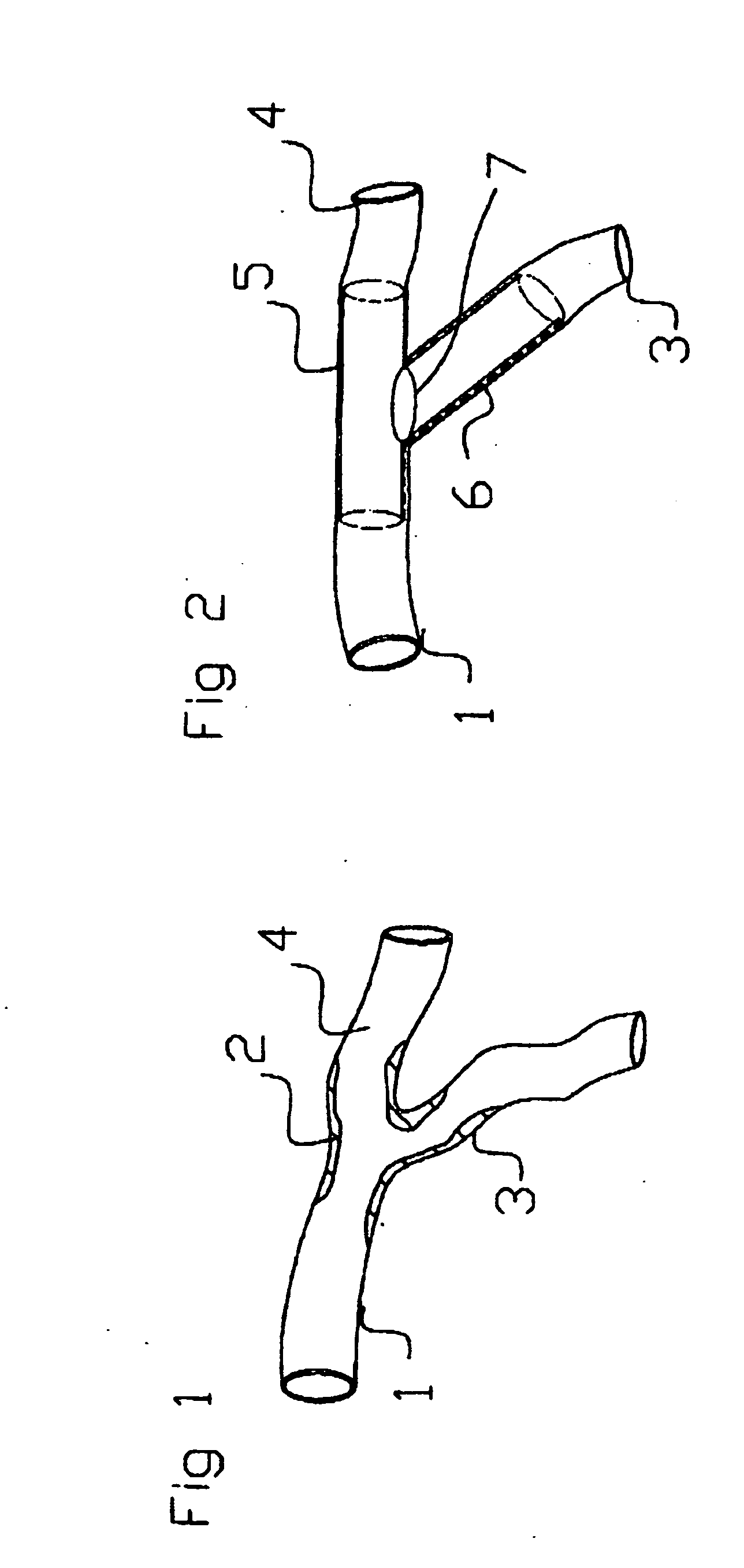 Catheter device for delivery of stents to bifurcated arteries