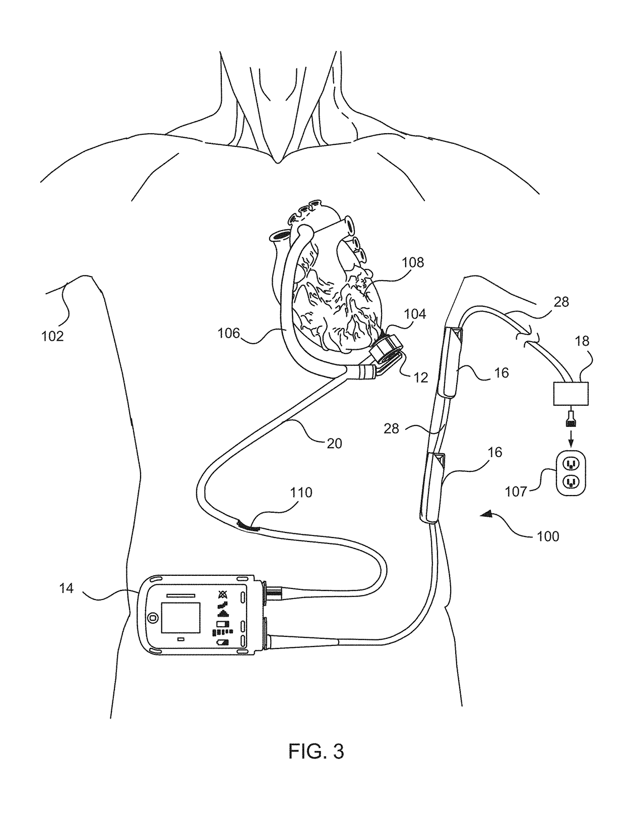 Connectors and cables for use with ventricle assist systems