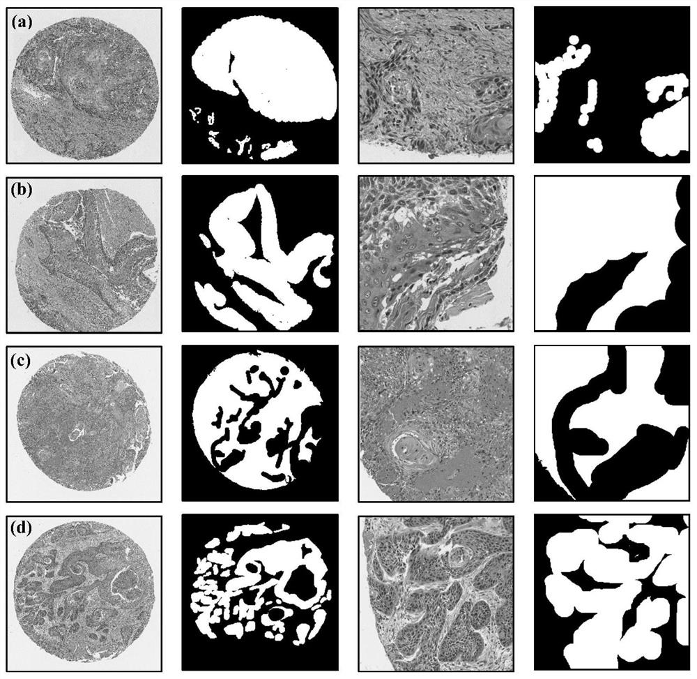 Automatic segmentation method for oral cancer epithelial tissue region of pathology image