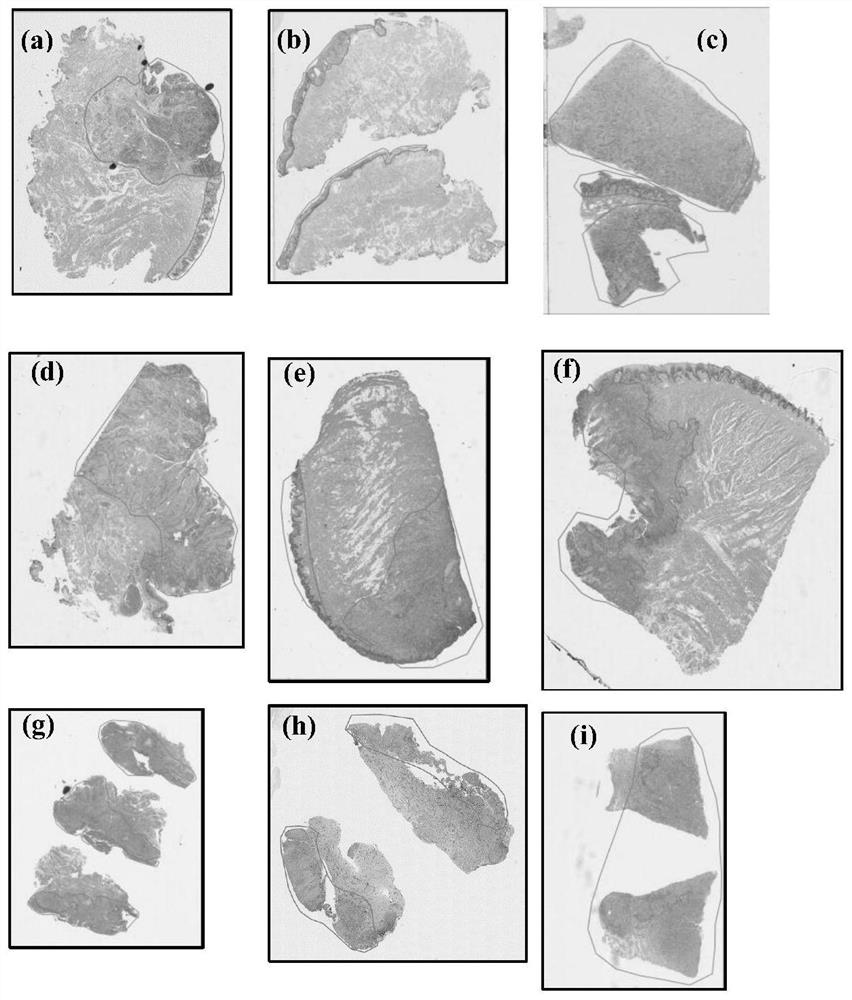 Automatic segmentation method for oral cancer epithelial tissue region of pathology image