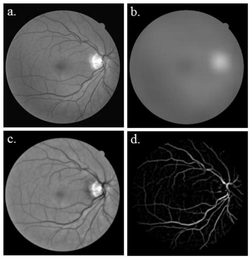Automatic retinal vessel segmentation method for glaucoma