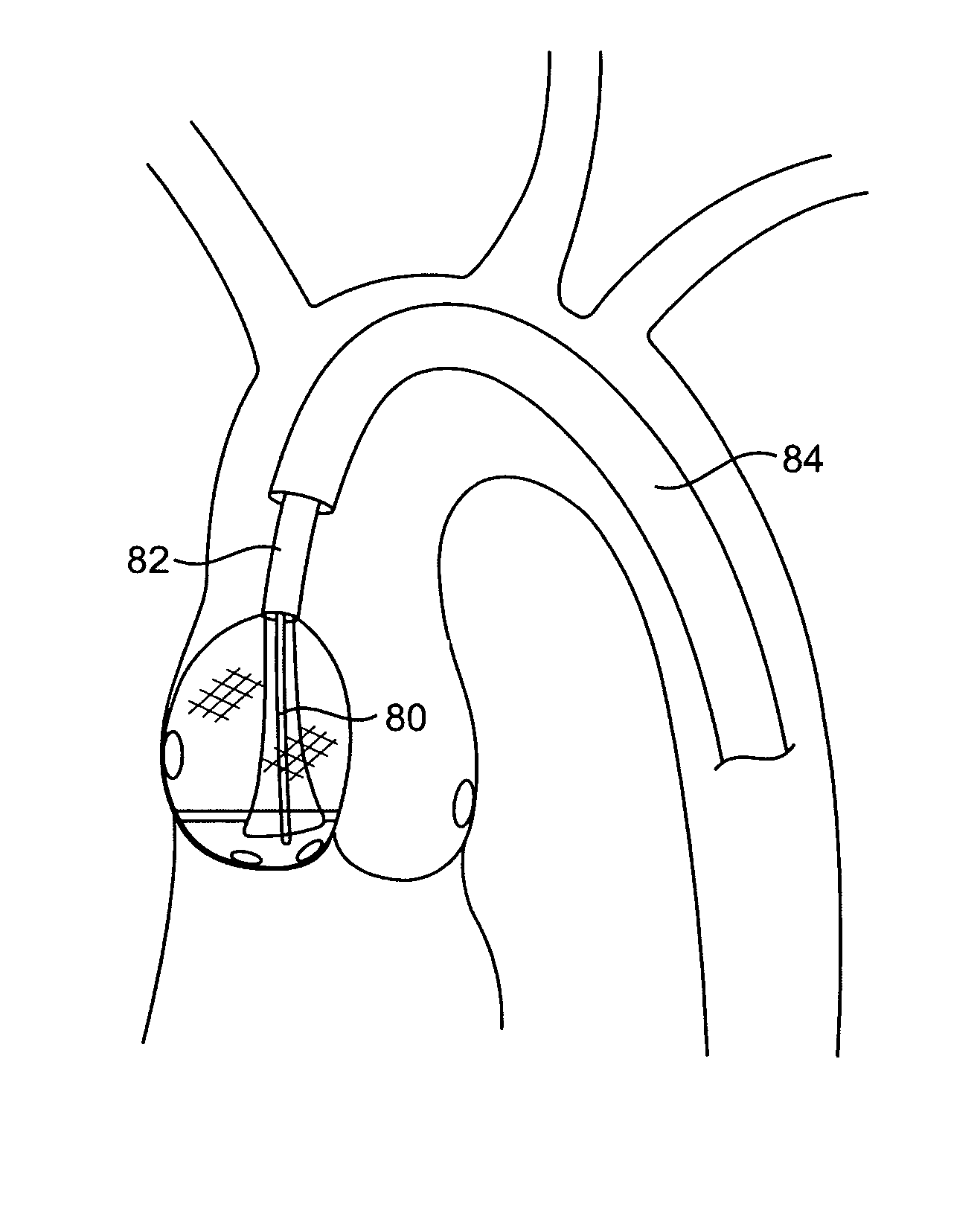 Aortic valve repair