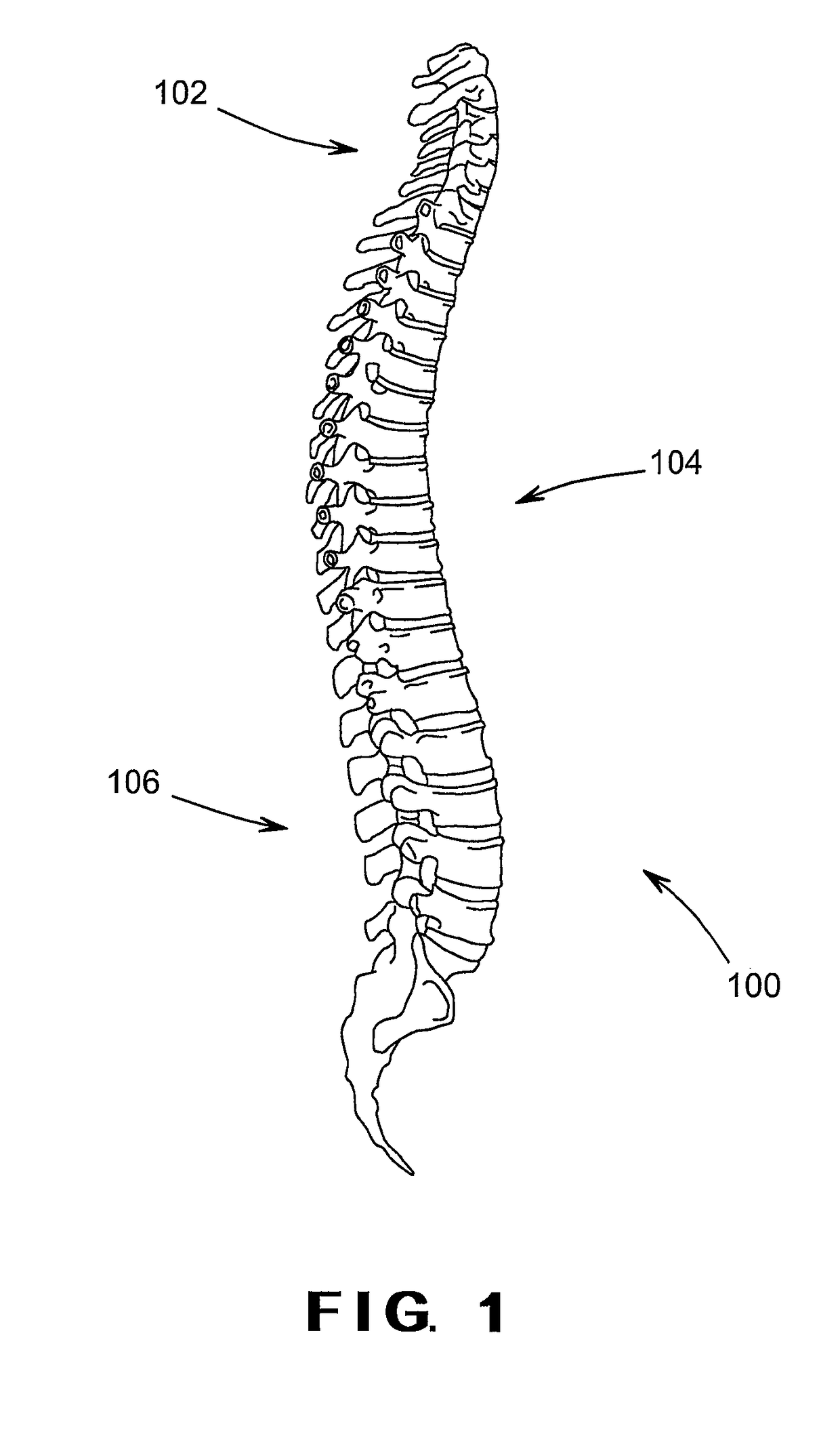 Devices and method for treatment of spondylotic disease