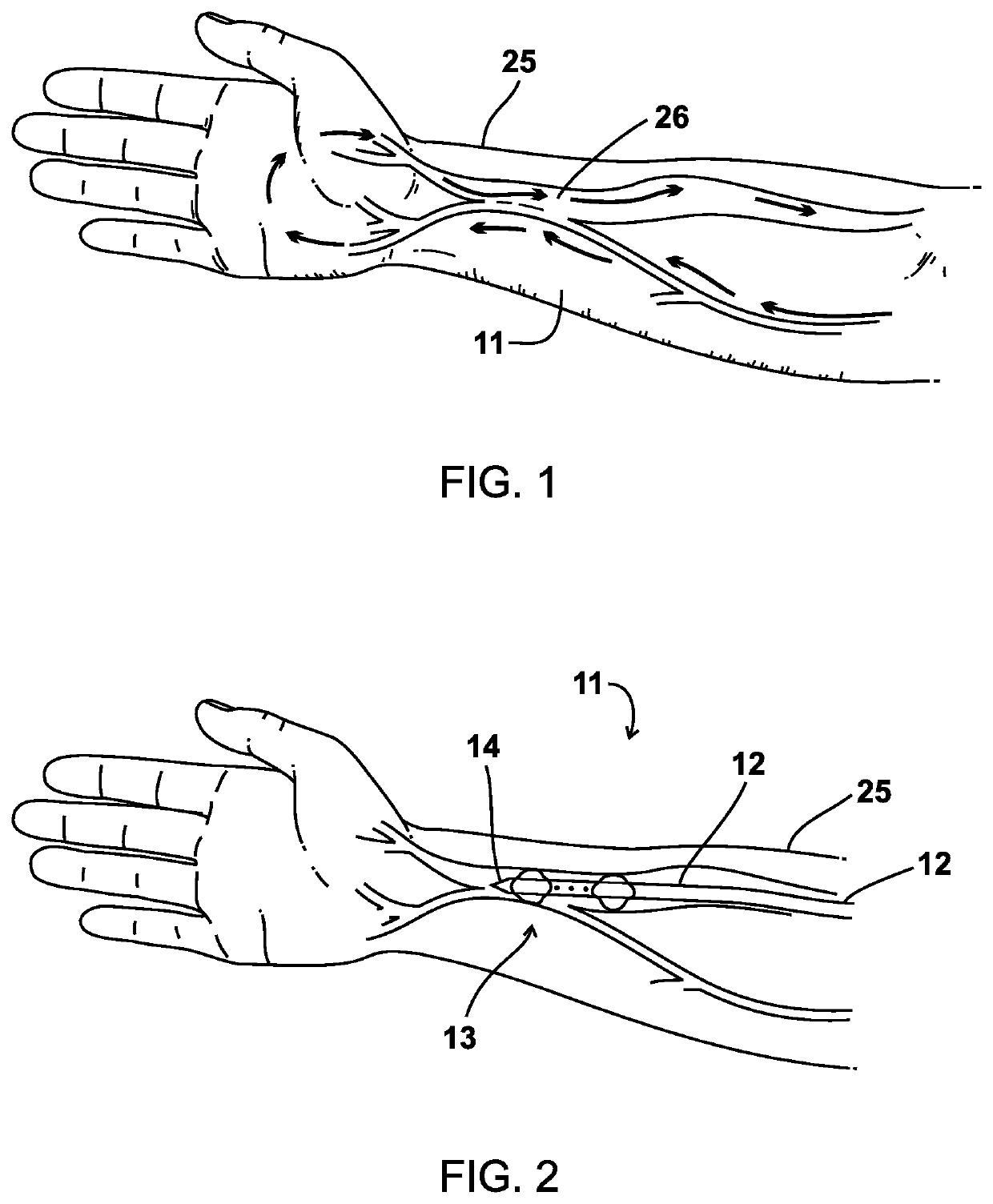 Method and apparatus for enhancing the maturation rate of an arteriovenous fistula