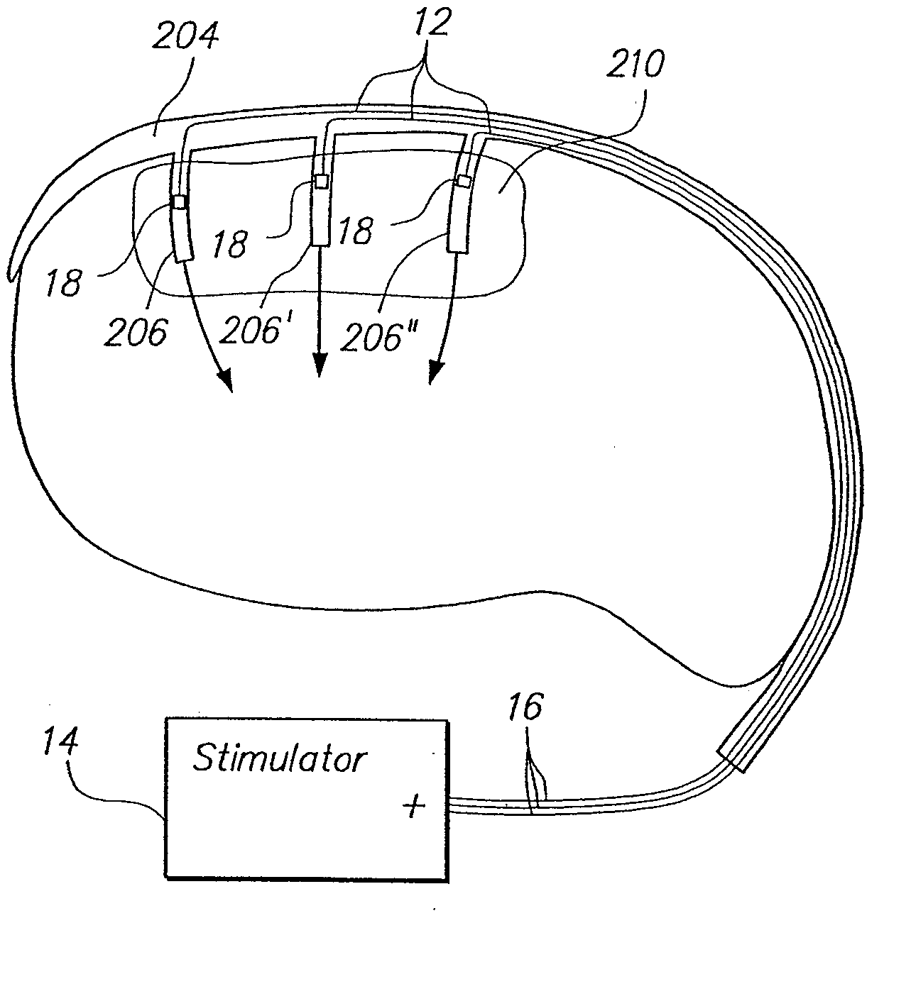 Method of intravascularly delivering stimulation leads into brain to stimulate the spg