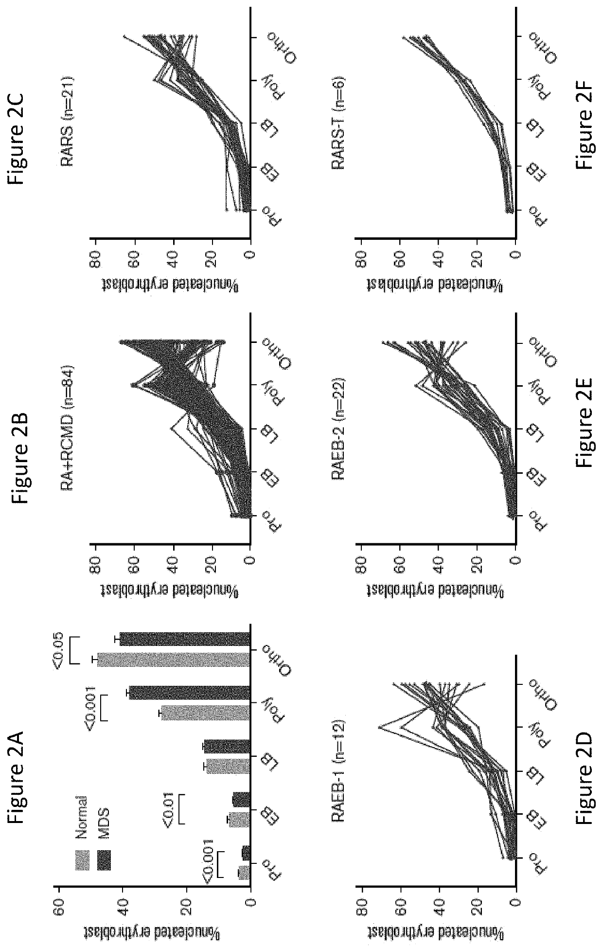 Terminal erythroid differentiation as a biomarker for prognosis and treatment, and therapeutic target in myeloid malignancies