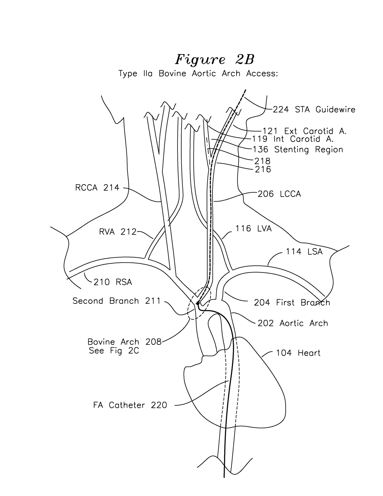 Method and apparatus for percutaneous superficial temporal artery access for carotid artery stenting