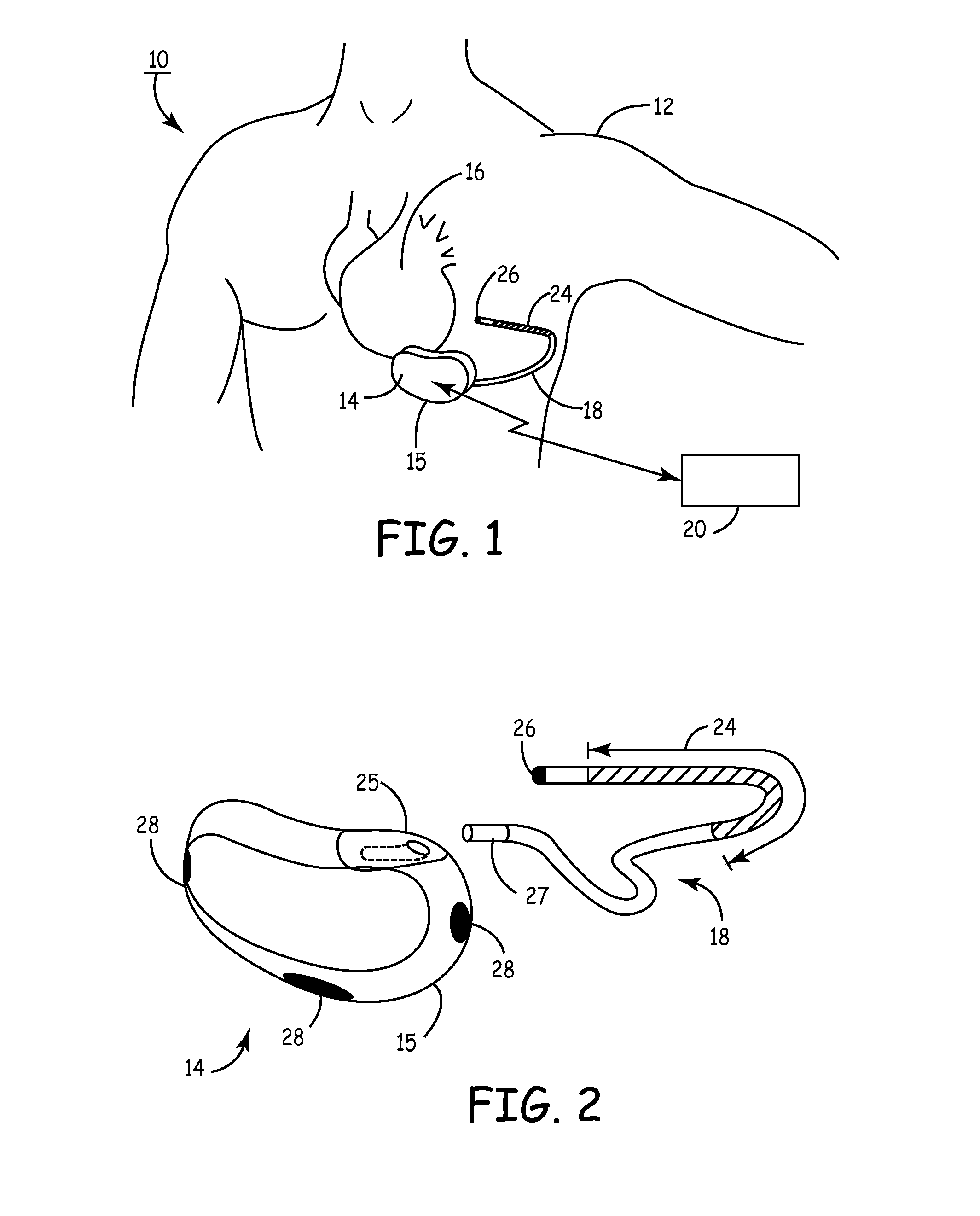 Method and apparatus for detecting arrhythmias in a medical device