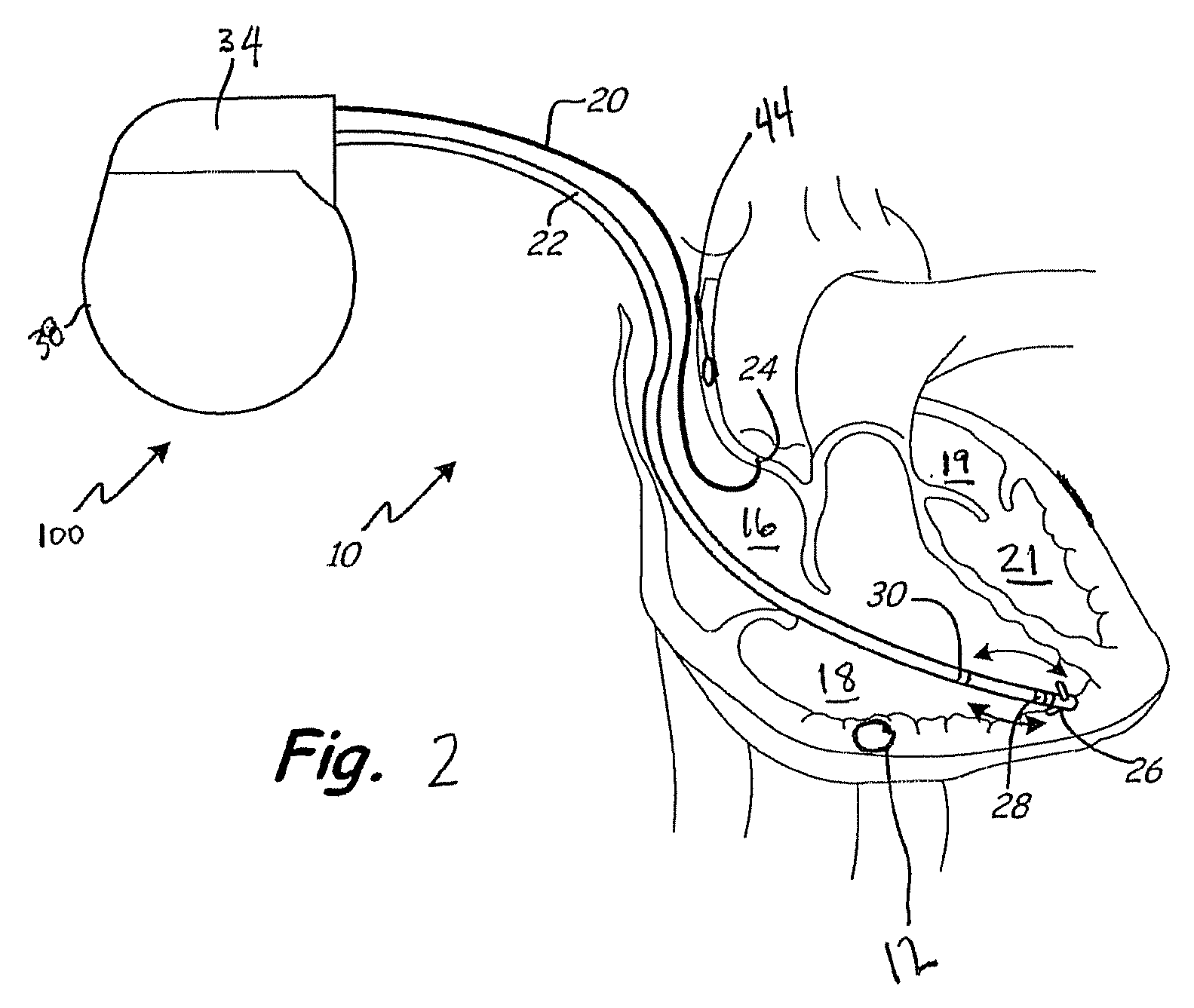 Electronic and biological pacemaker systems