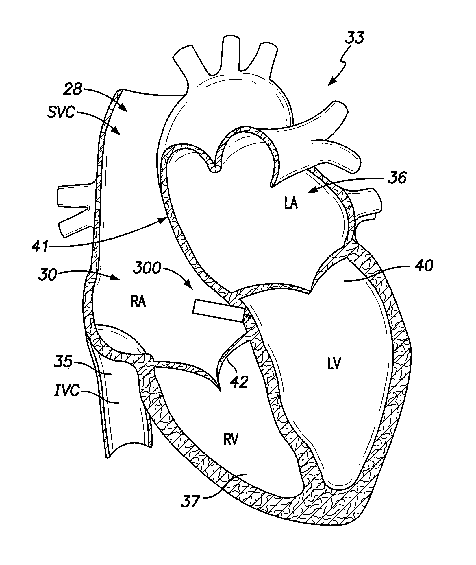 Single-chamber leadless intra-cardiac medical device with dual-chamber functionality and shaped stabilization intra-cardiac extension