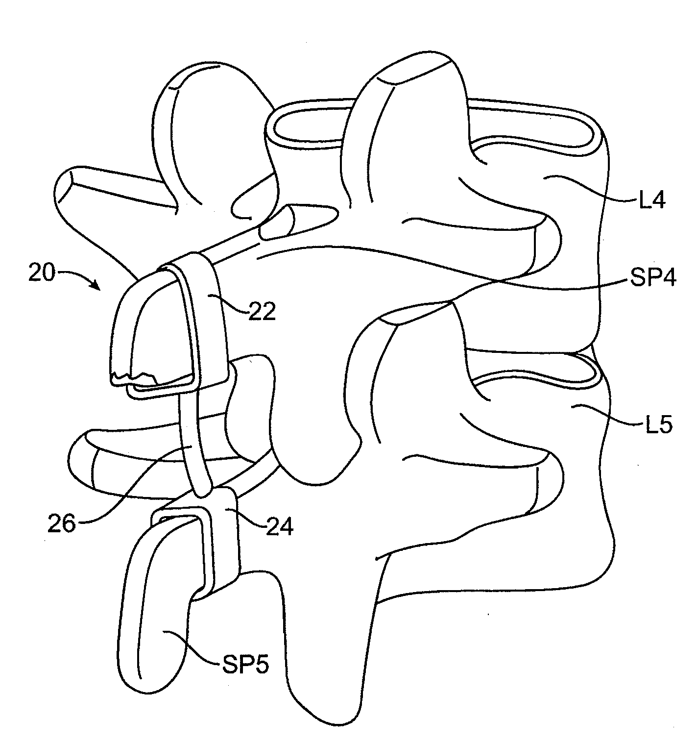 Structures and methods for constraining spinal processes with single connector