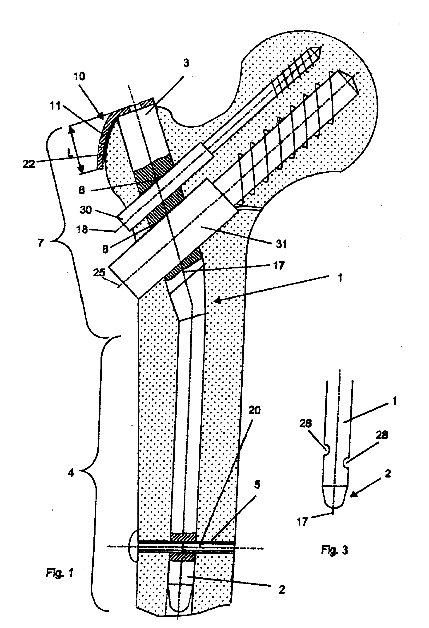 Device for Bone Fixation