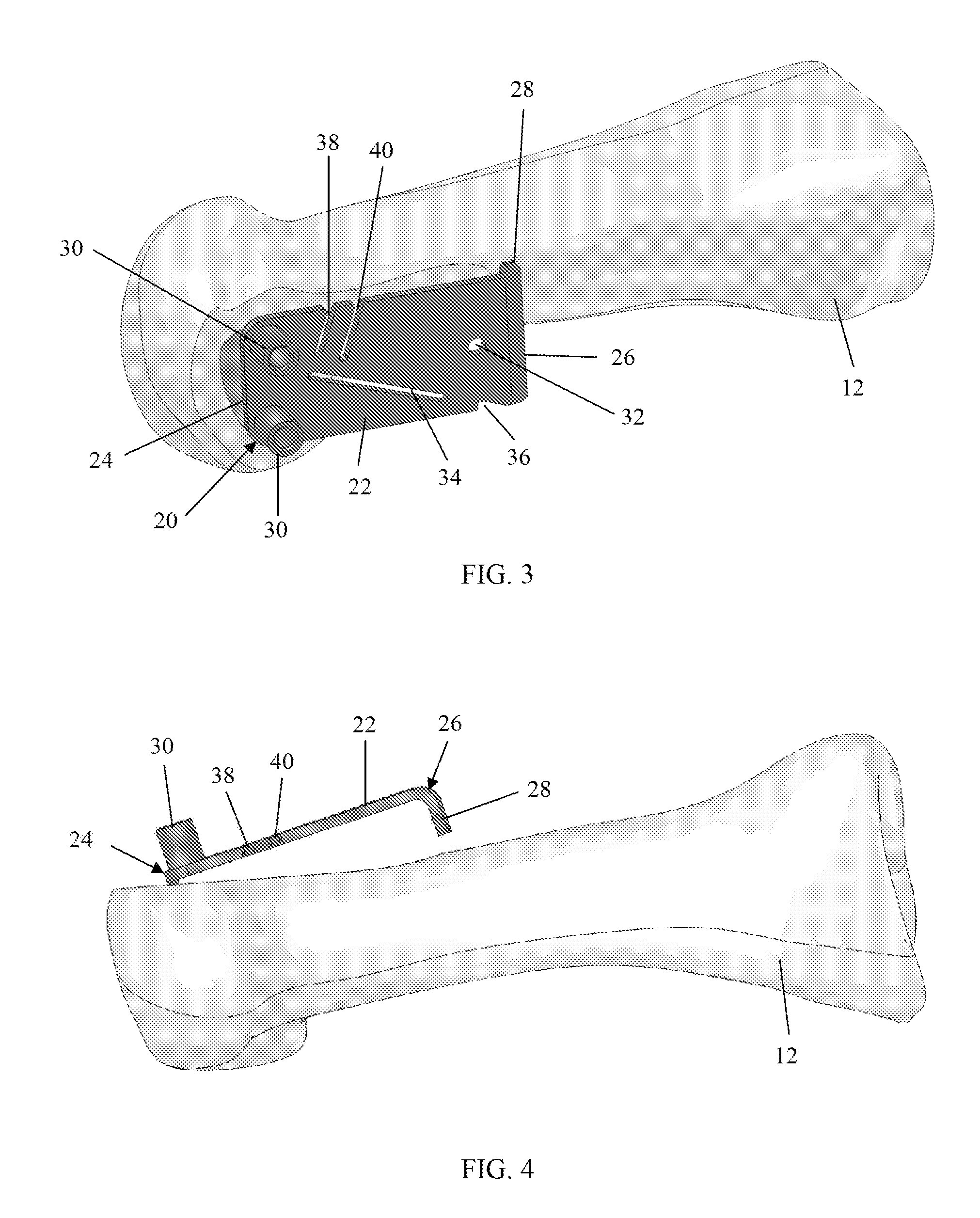 Resection guides, implants and methods