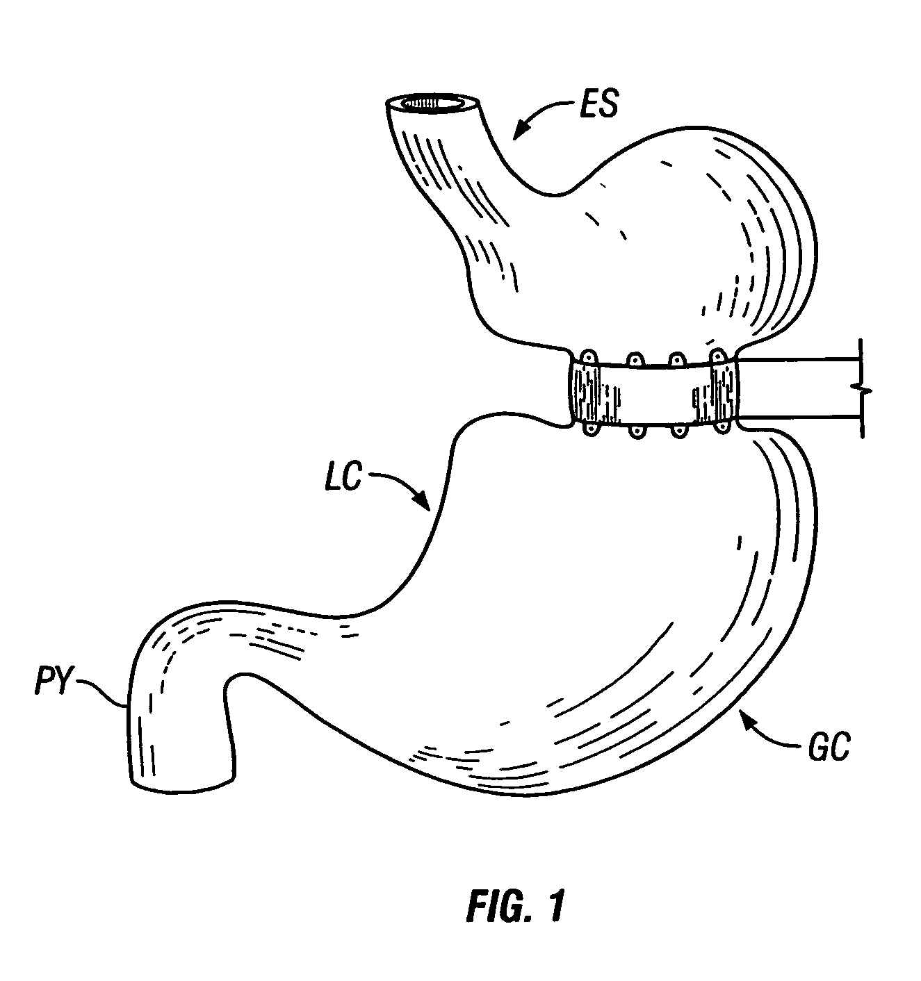 Method and device for use in endoscopic organ procedures