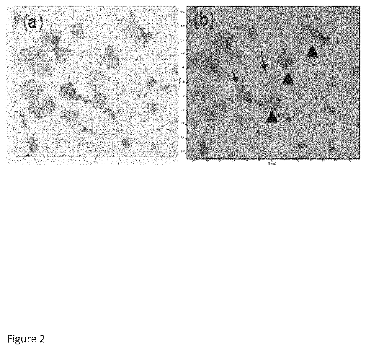 Method for identification of low grade cervical cytology cases likely to progress to high grade/cancer